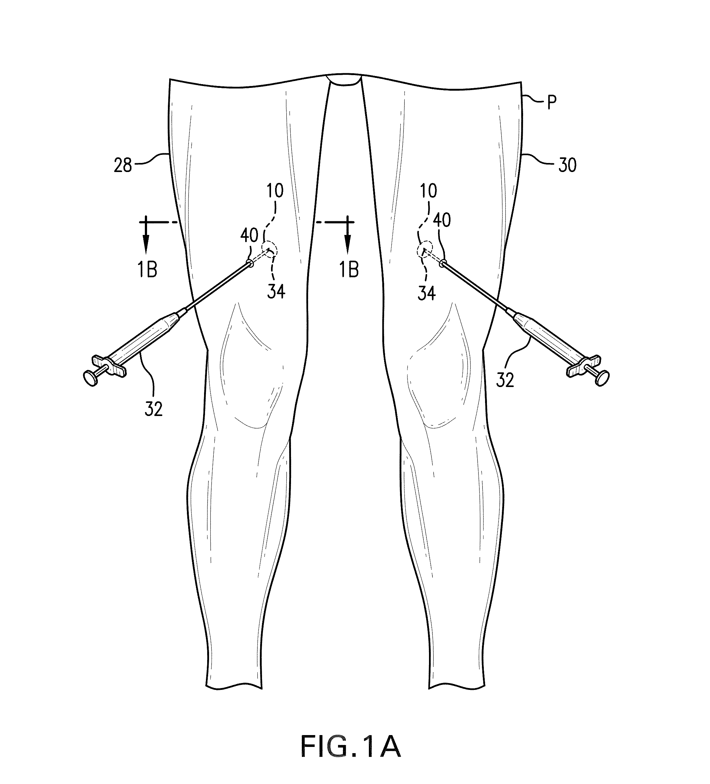 Method for Treating and Confirming Diagnosis of Exertional Compartment Syndrome