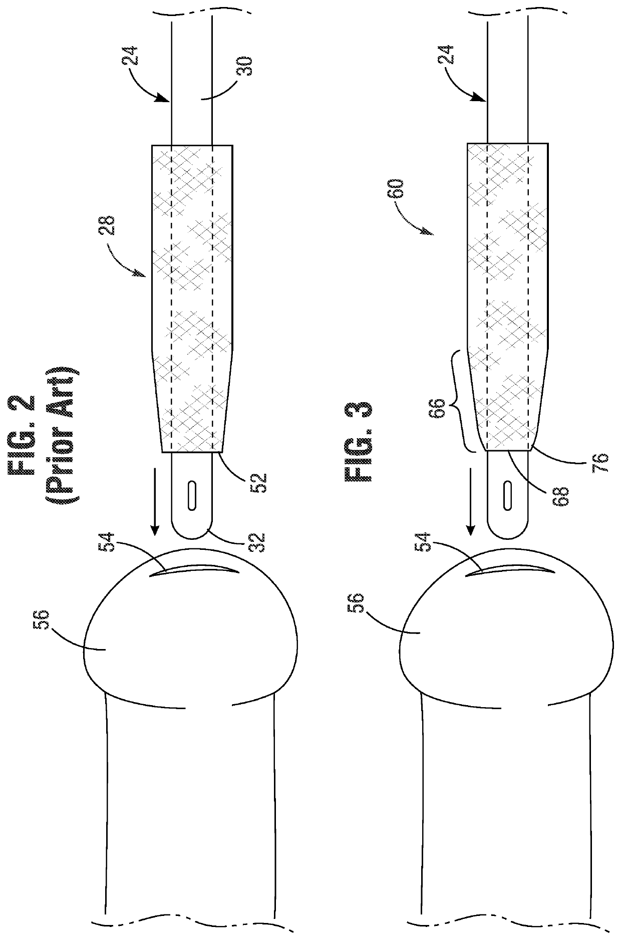 Gripper sleeve for urinary catheter