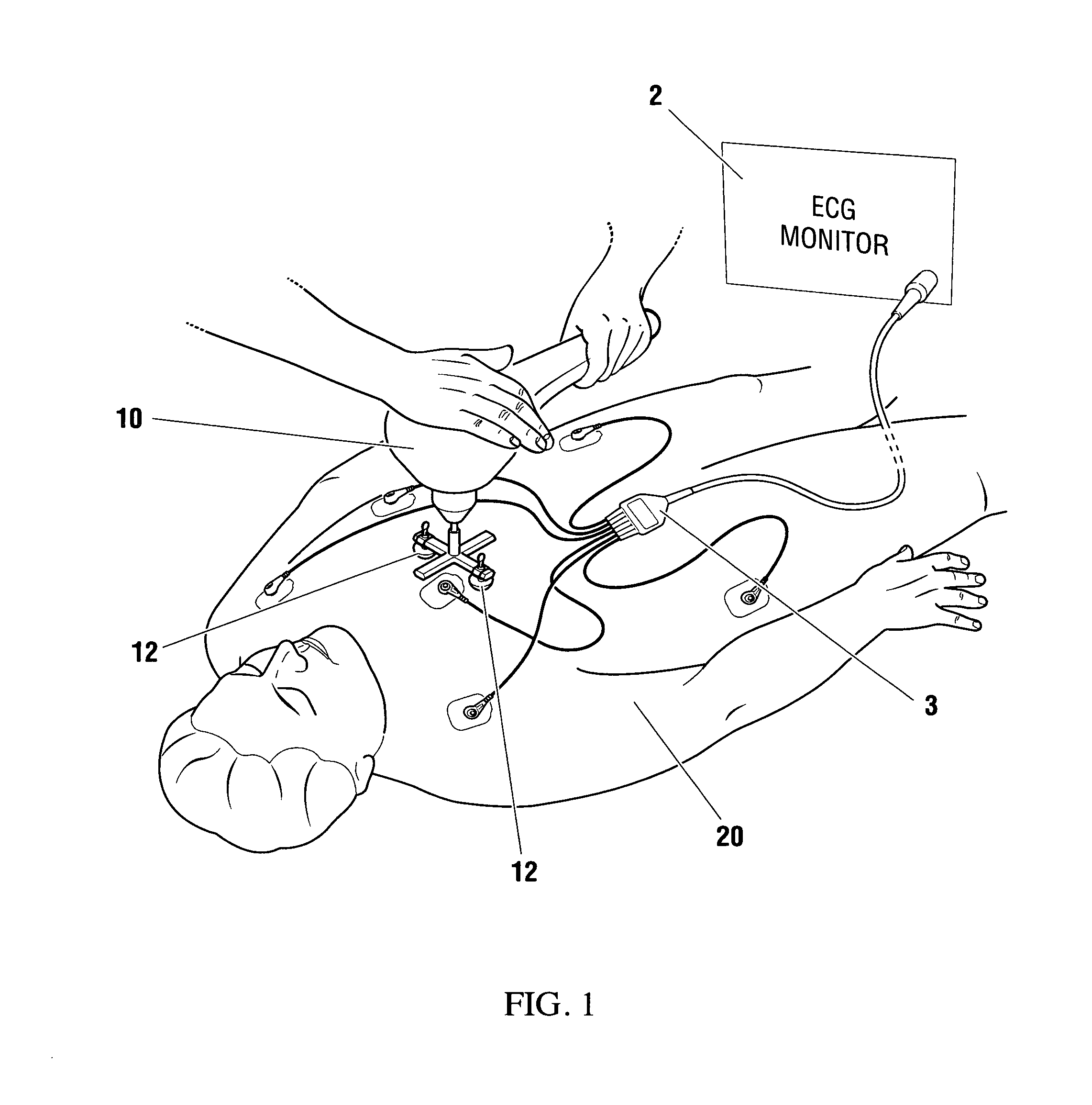 Vibration method for clearing acute arterial thrombotic occlusions in the emergency treatment of heart attack and stroke