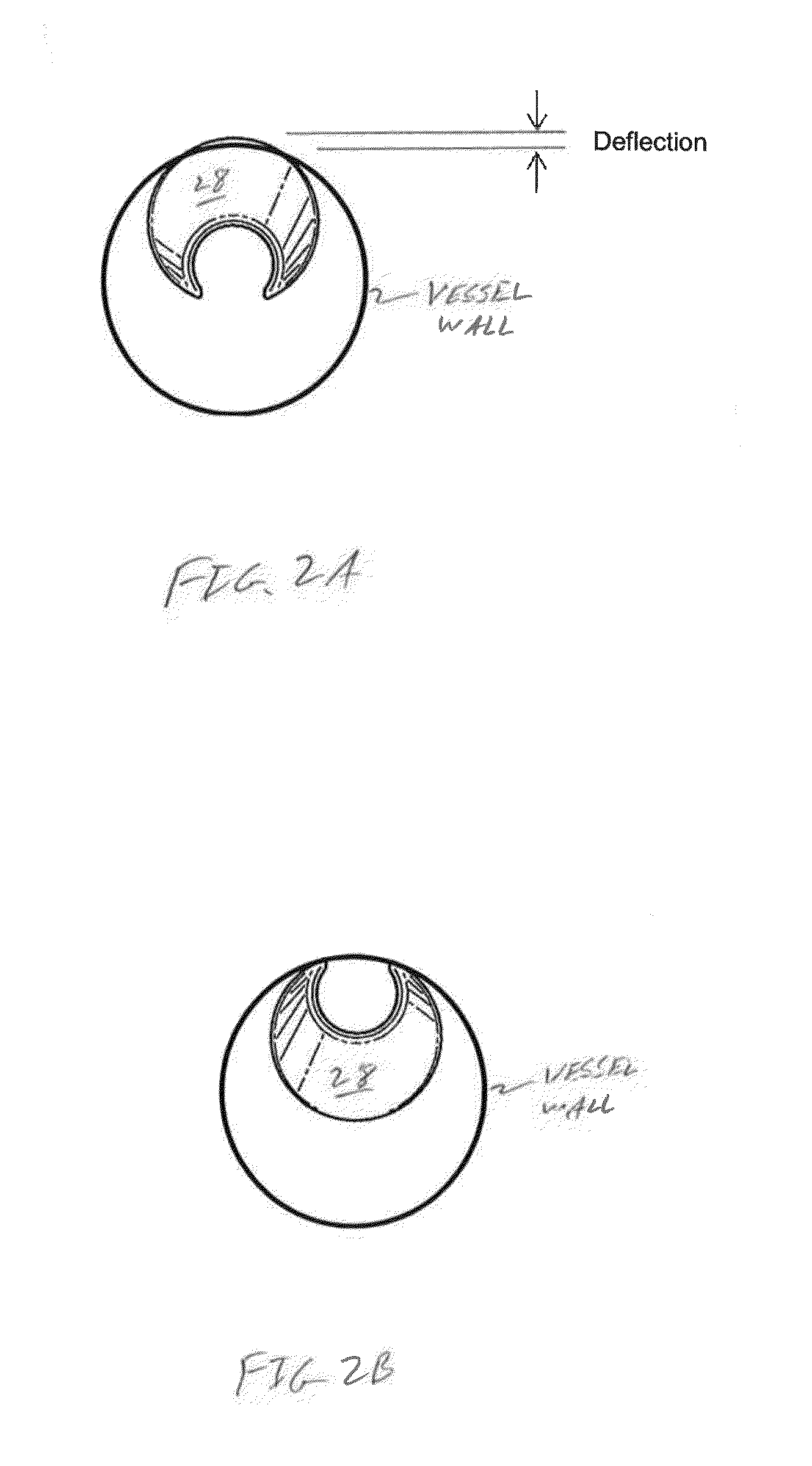 Methods and systems for disrupting calcified walls of biological conduits and calcified lesions therein