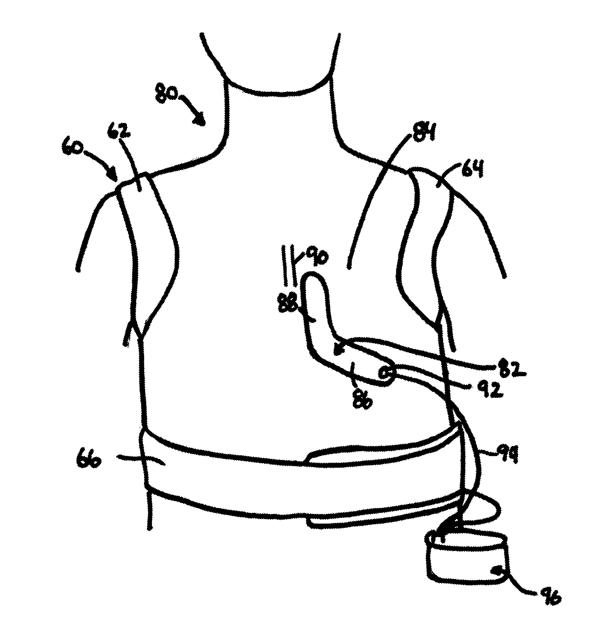 Automatic external defibrillator for implatable cardiac defibrillator patients undergoing procedures involving electromagnetic interference