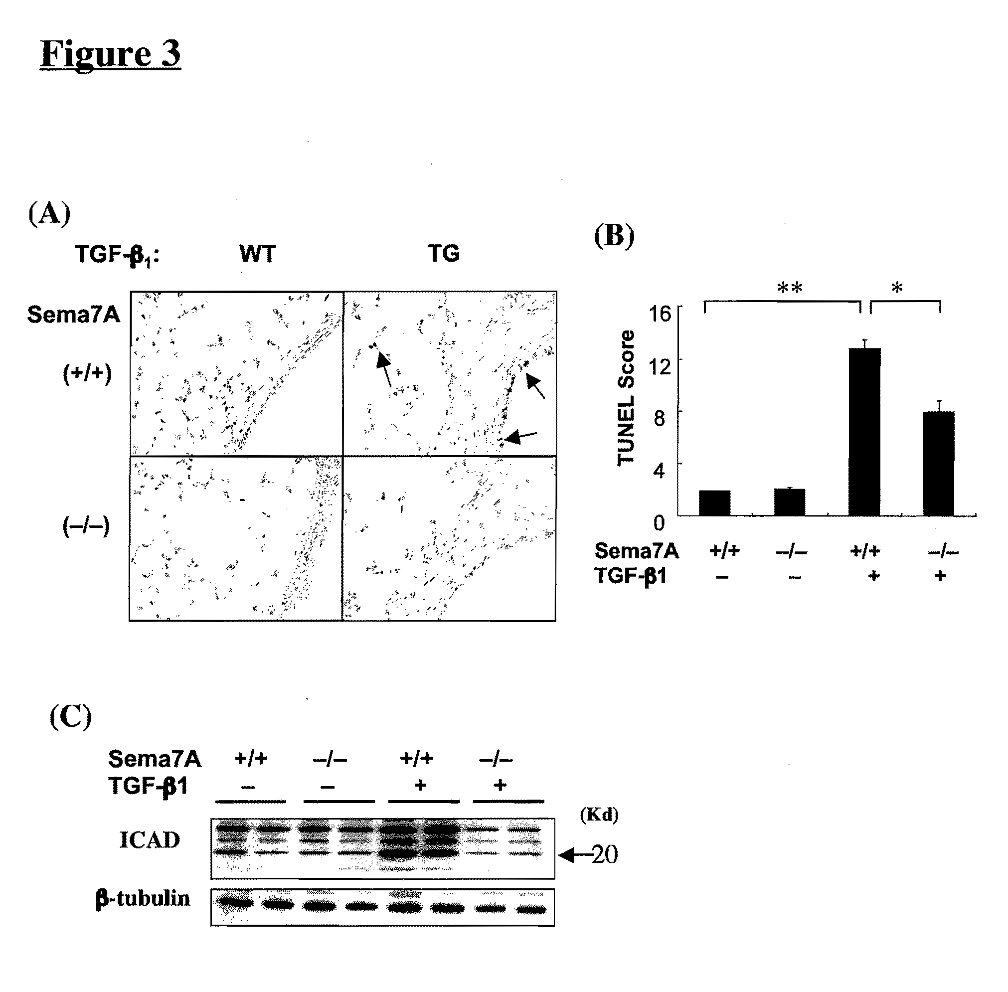 Semaphorin 7A Plays a Critical Role in TGF-Beta1-Induced Pulmonary Fibrosis and Alveolar Destruction