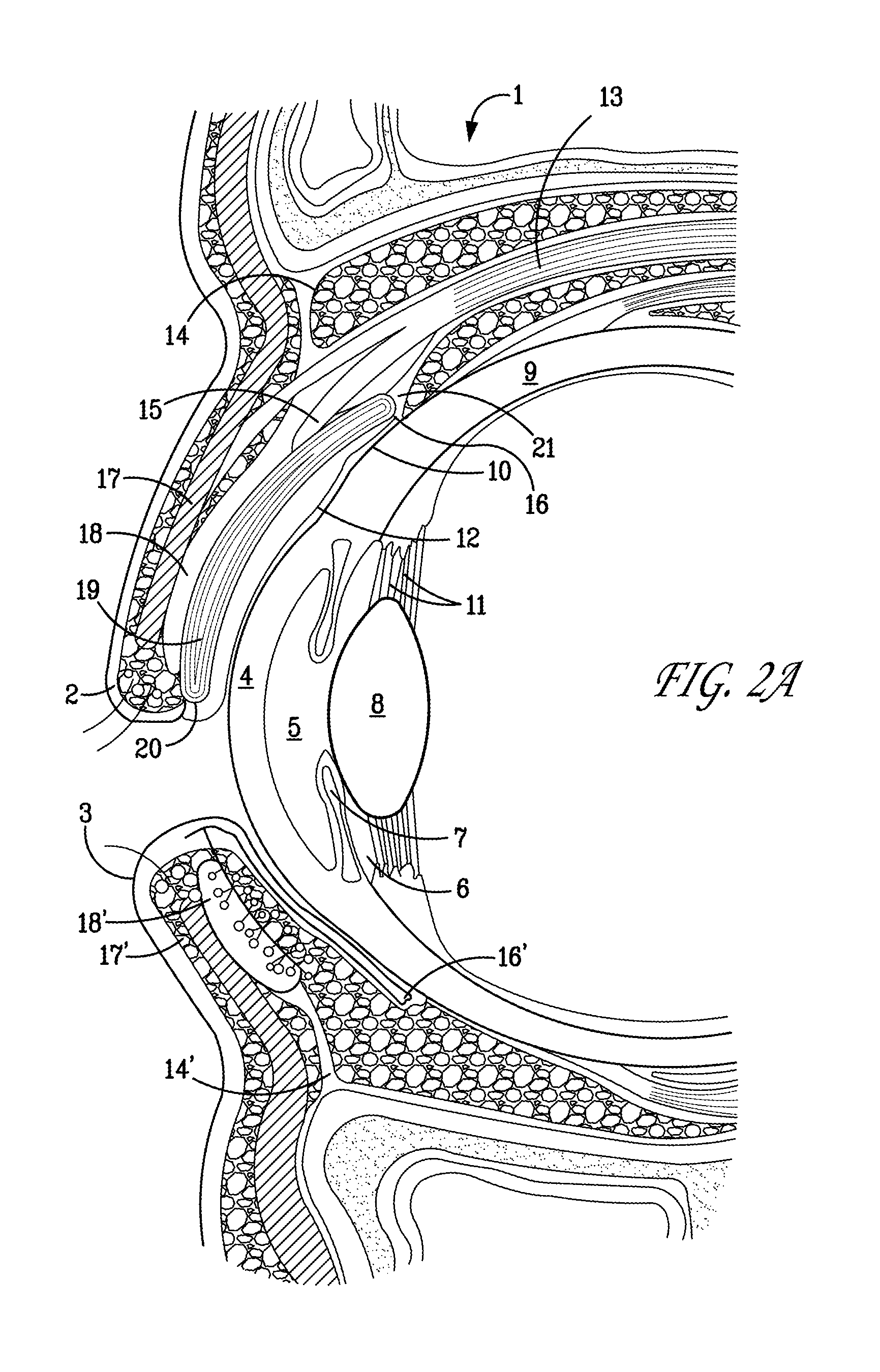 Surgical correction of ptosis by polymeric artificial muscles