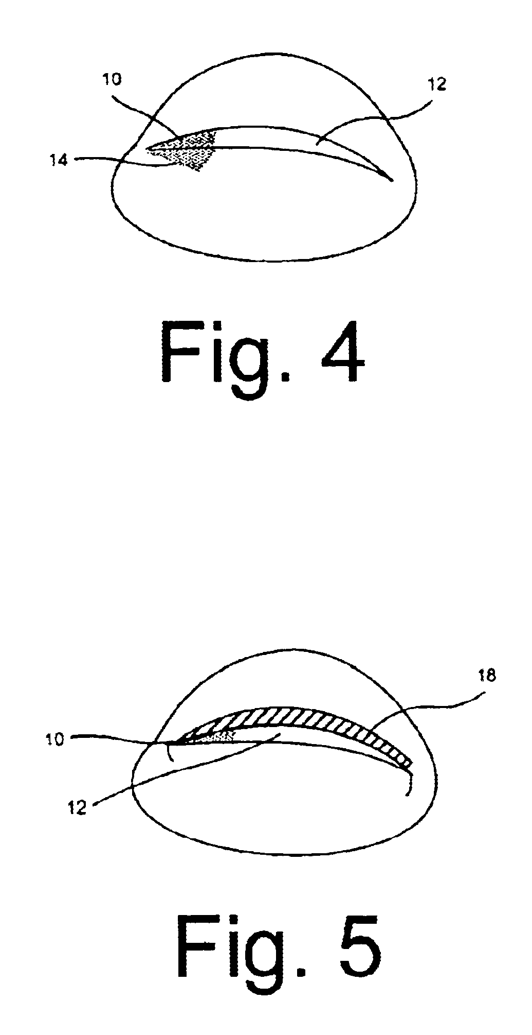 Treatment modality and method for fungal nail infection