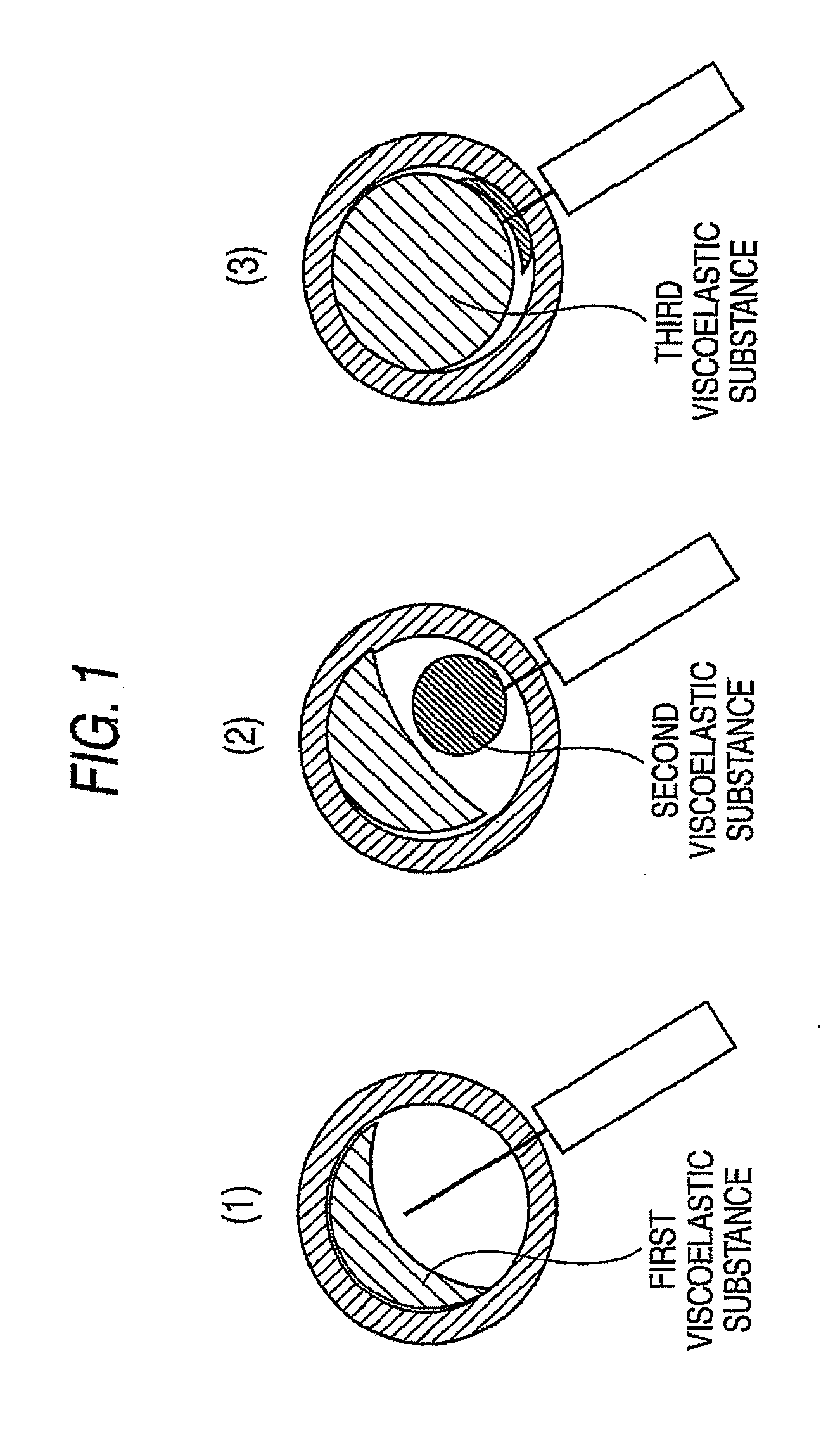 Method of ophthalmic surgery and kit therefor