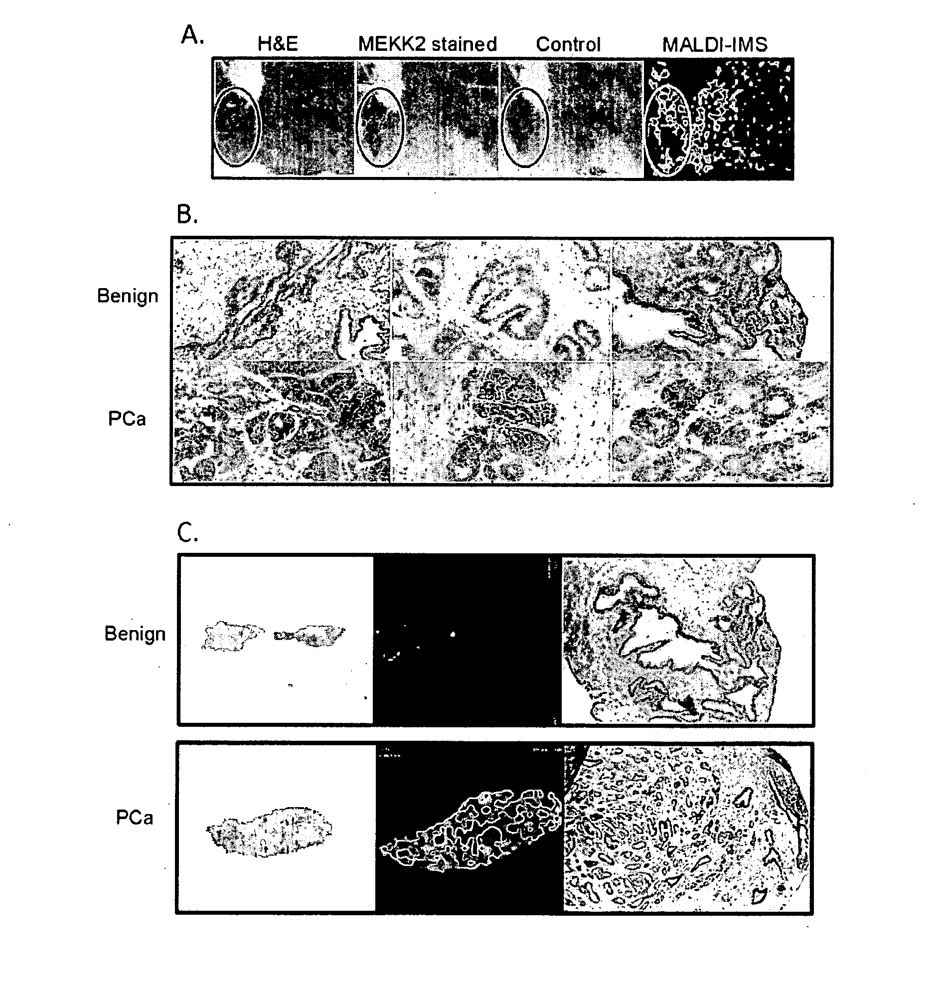 Imaging Mass Spectrometry for Improved Prostrate Cancer Diagnostics