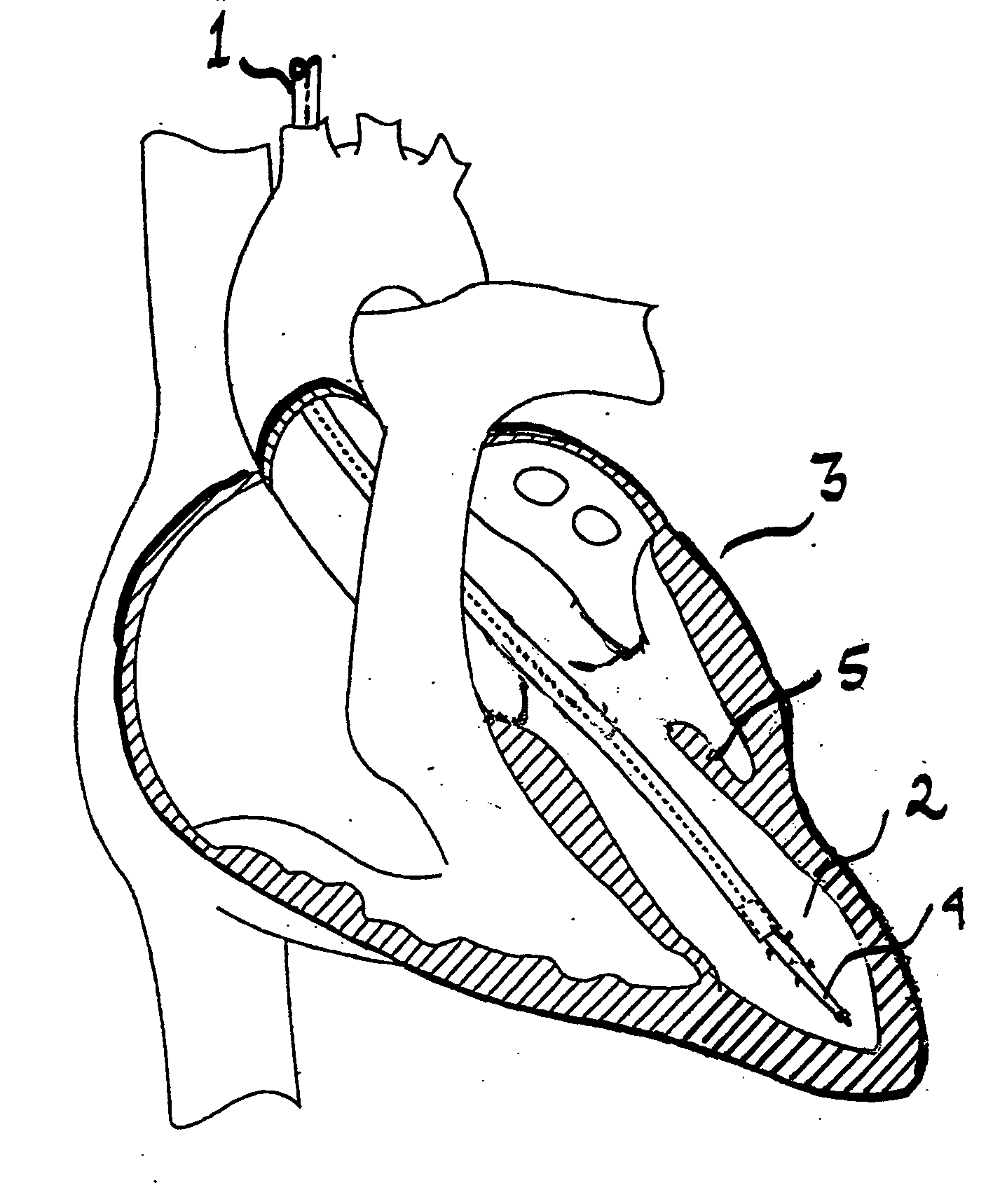 System for improving diastolic dysfunction