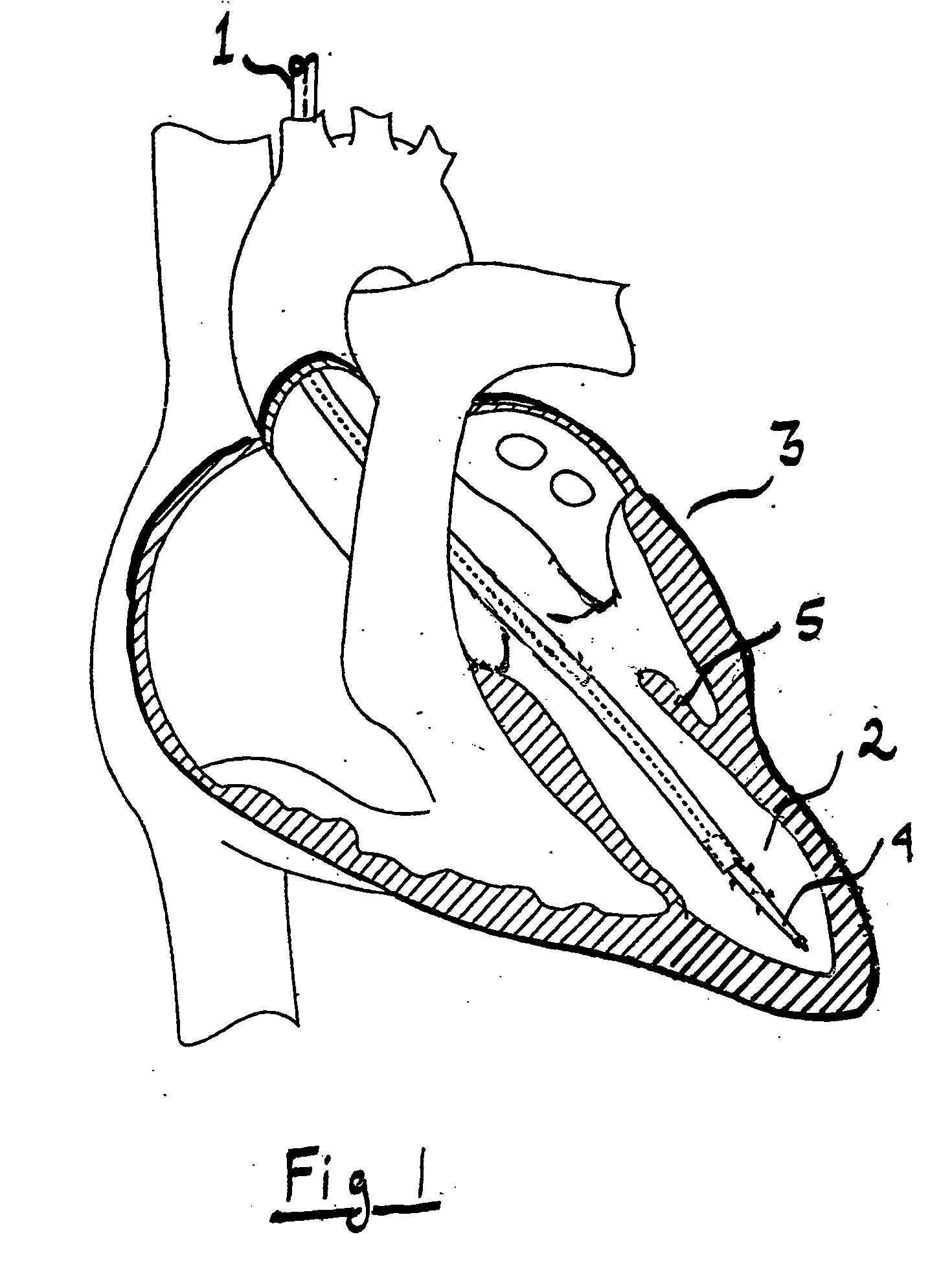 System for improving diastolic dysfunction