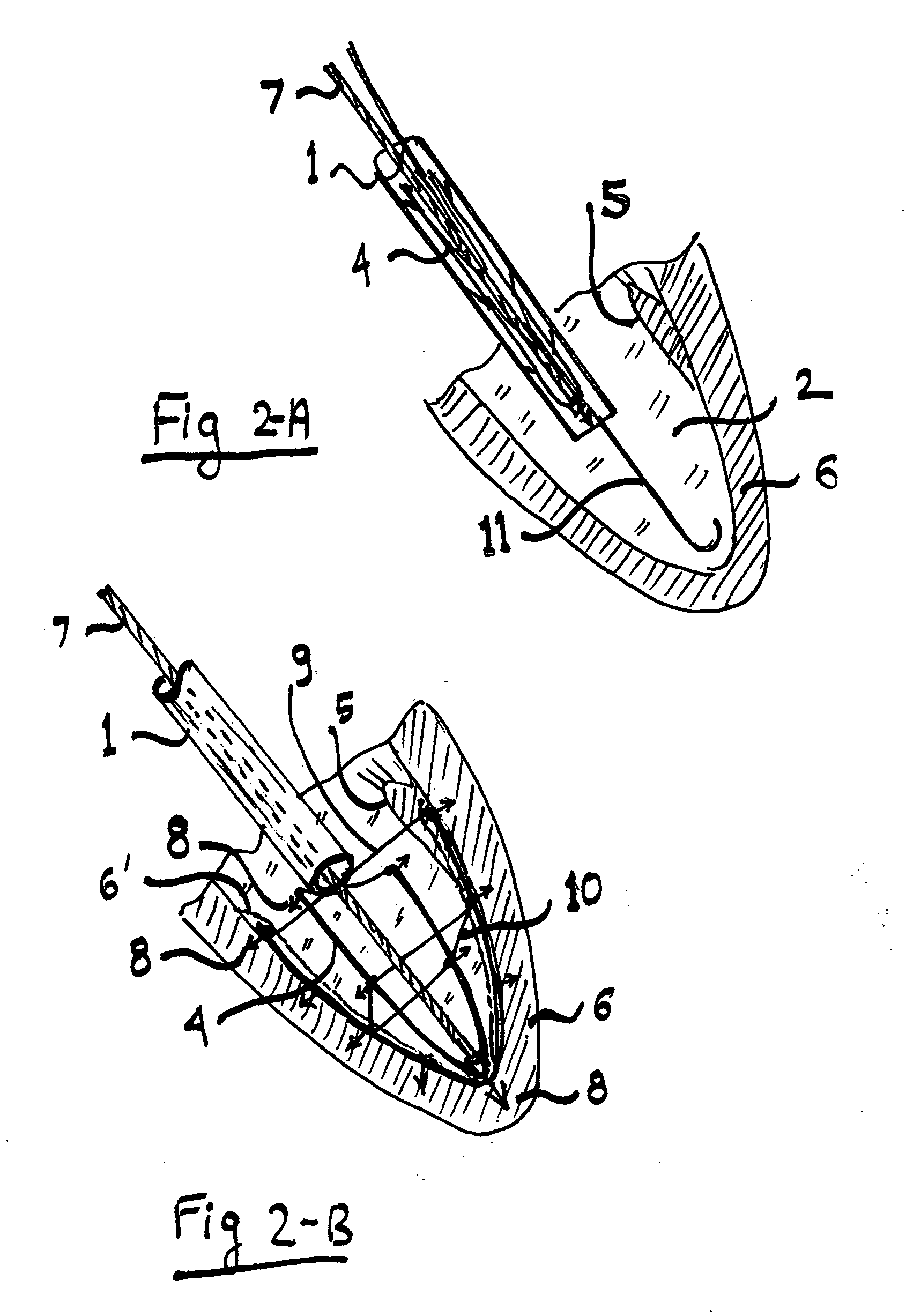 System for improving diastolic dysfunction