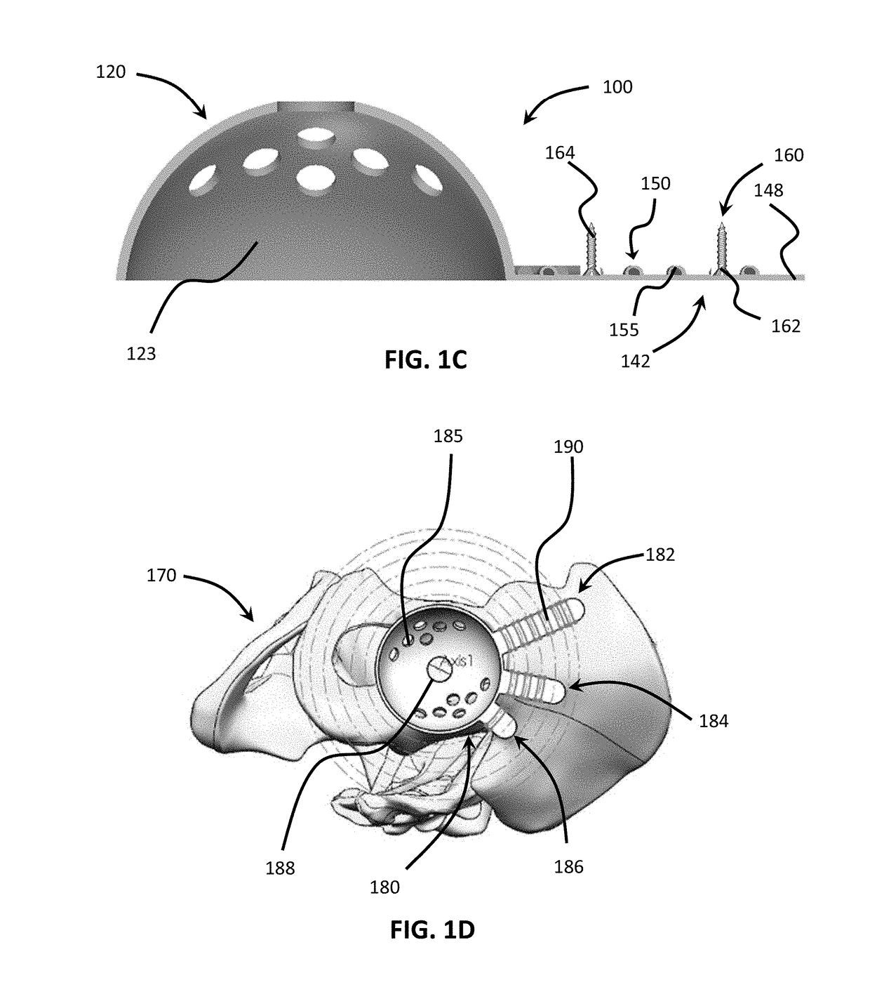 Patient-specific implant flanges with bone side porous ridges