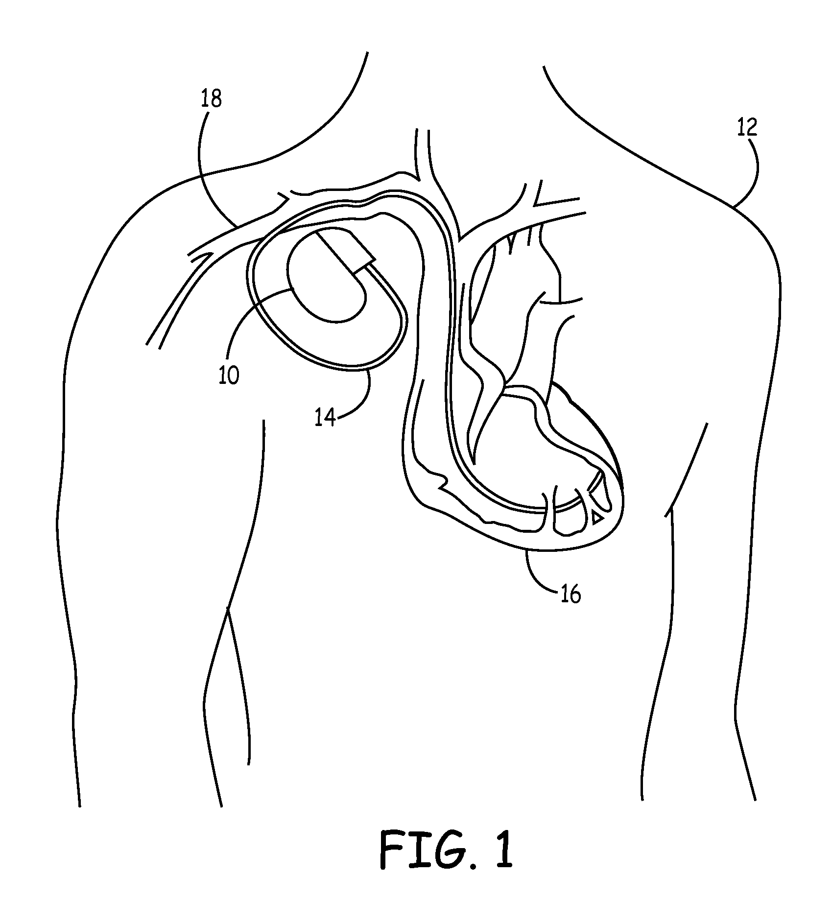 Electromagnetic interference alarm