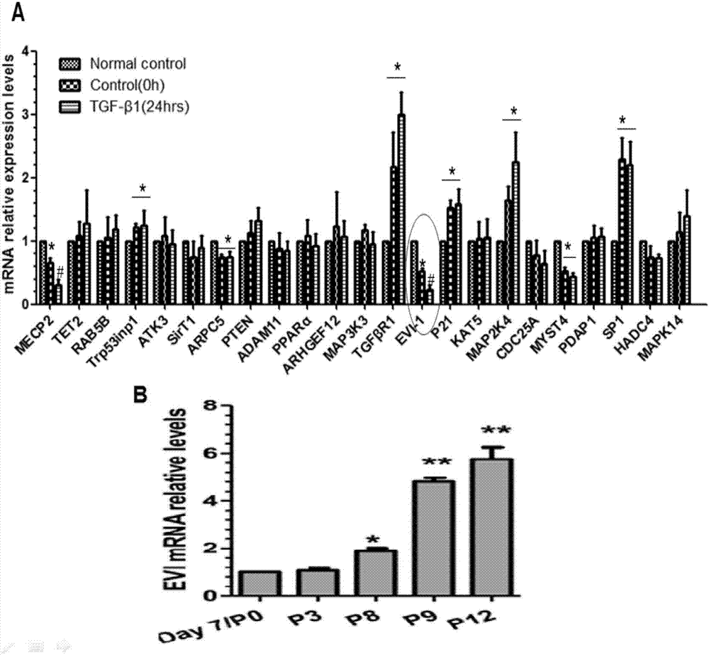 Application of EVI-1 inhibitor for preparing medicines for treating vascular anomaly remodeling diseases