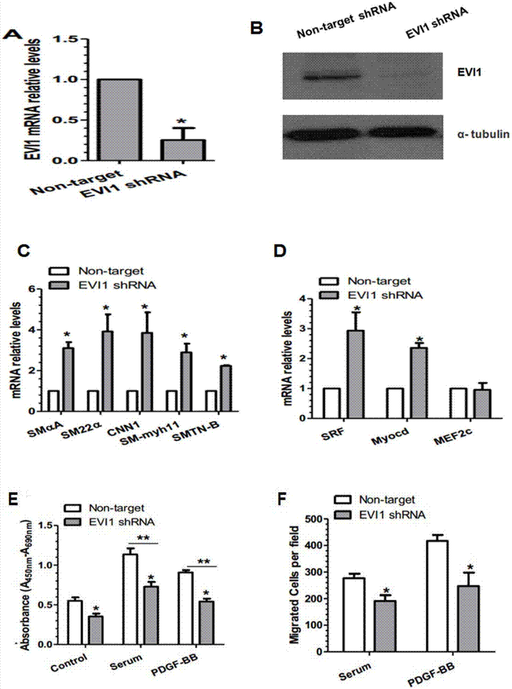 Application of EVI-1 inhibitor for preparing medicines for treating vascular anomaly remodeling diseases