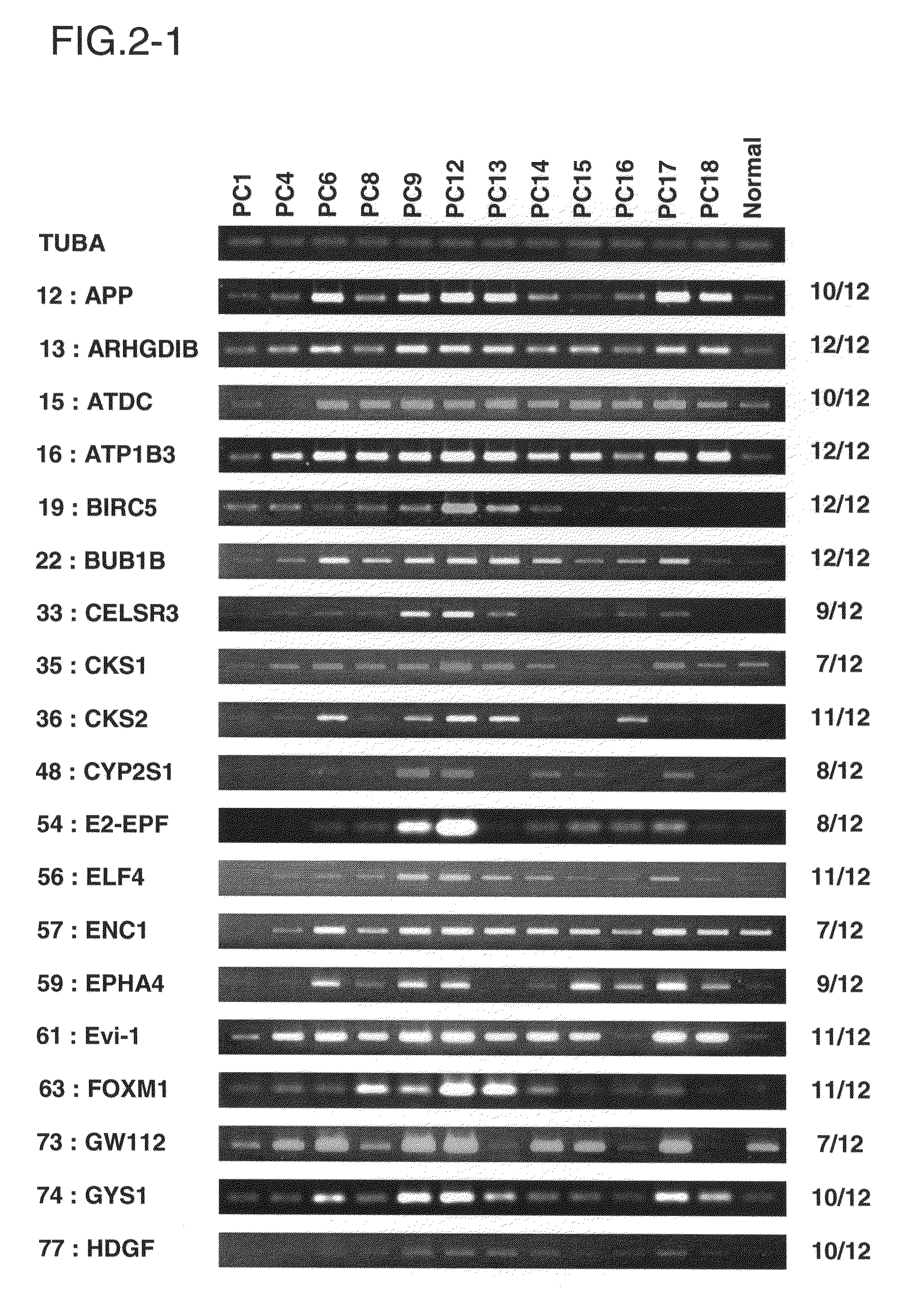 Method for diagnosing pancreatic cancer