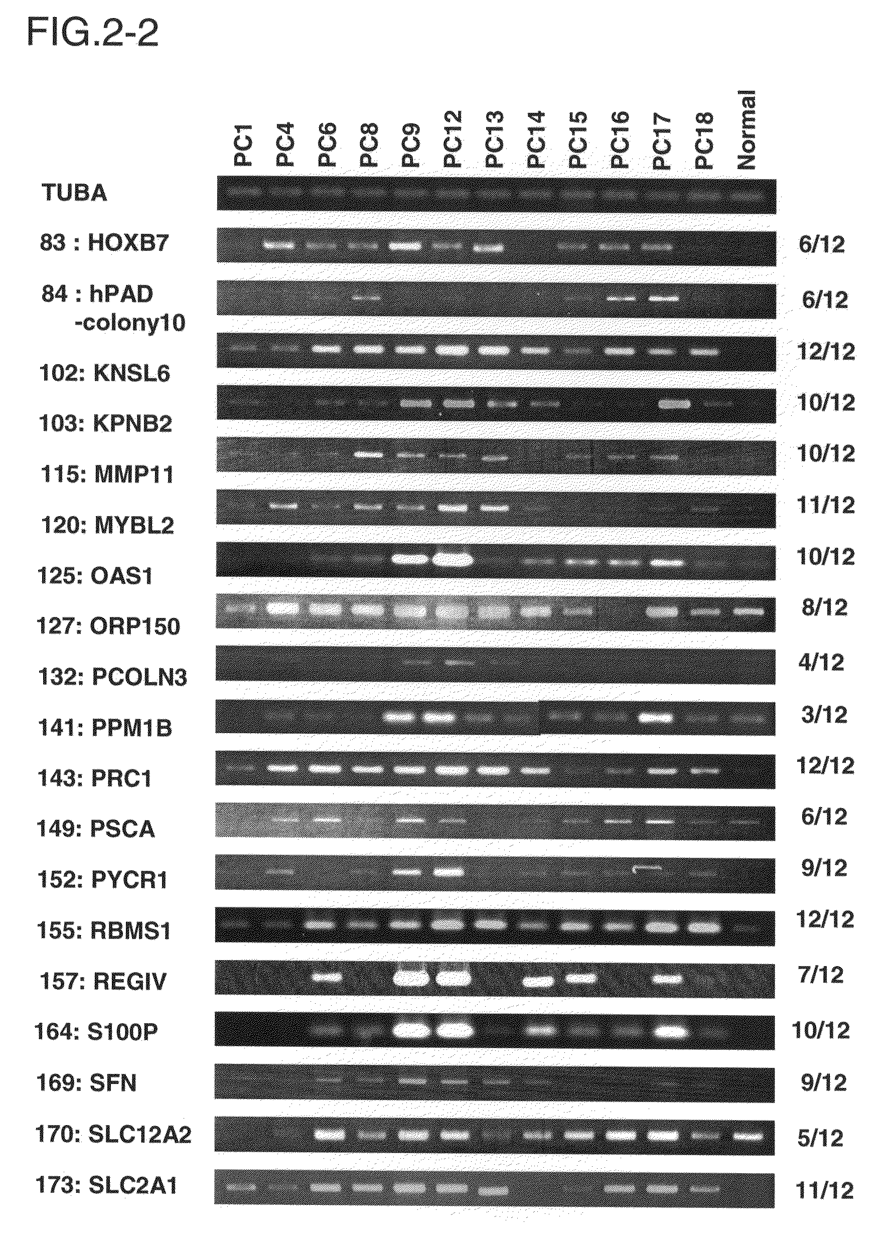 Method for diagnosing pancreatic cancer