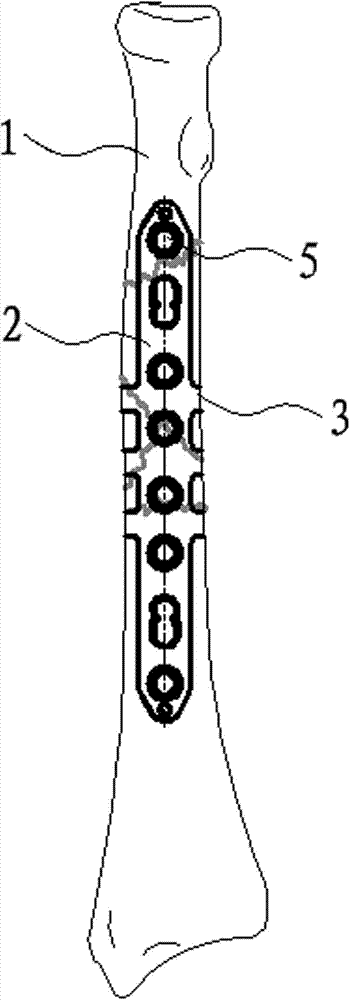 Ulna thread-type protection steel plate