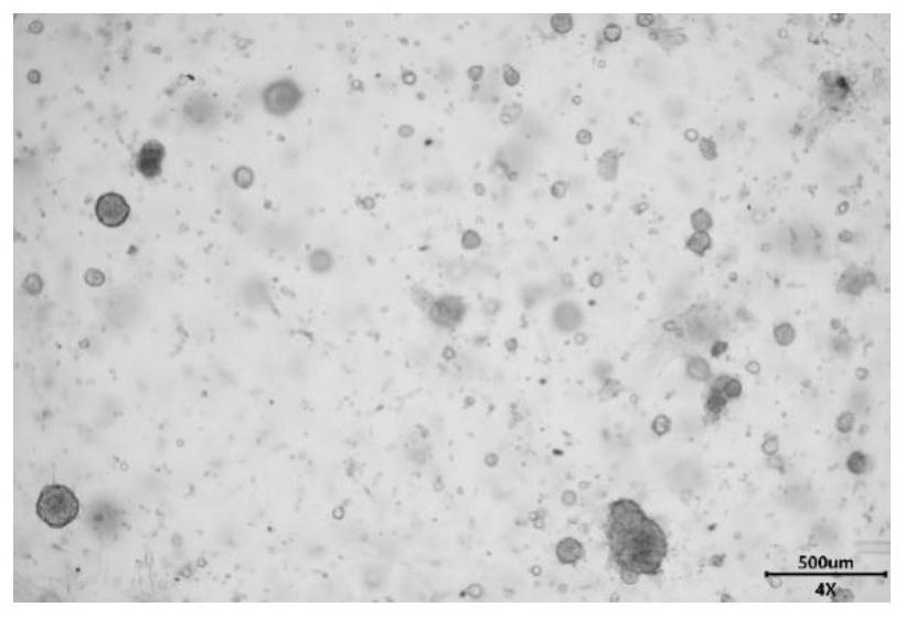 A special culture medium and 3D culture method for breast cancer organoids