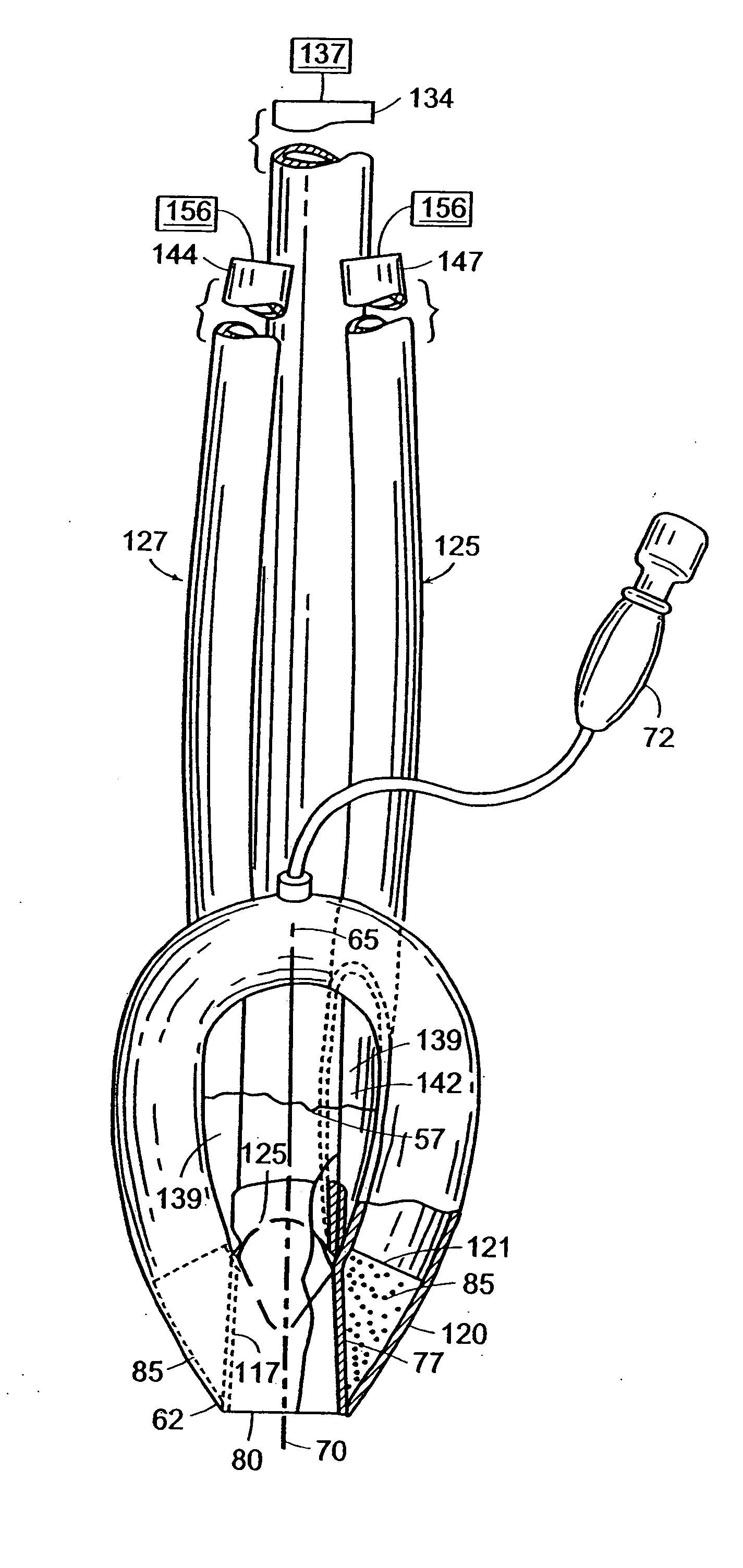 Laryngeal mask with large-bore gastric drainage