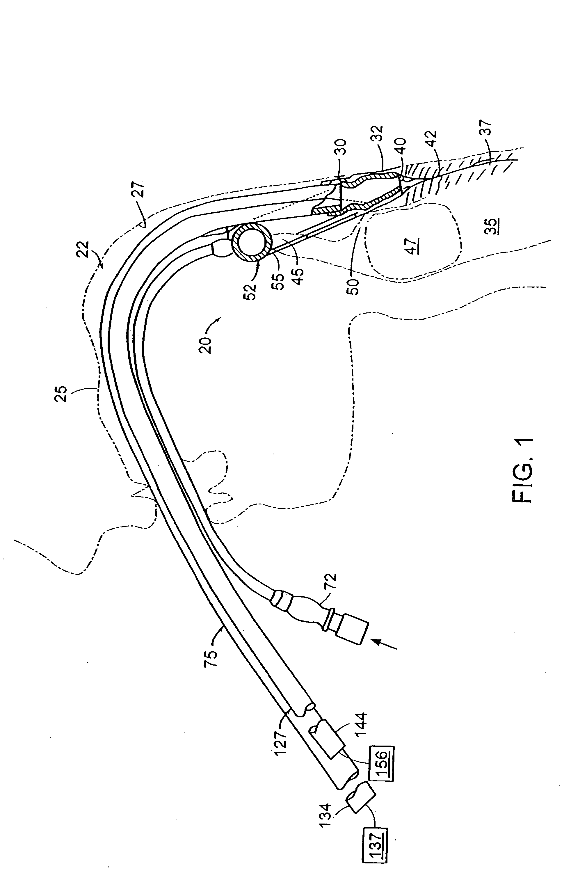 Laryngeal mask with large-bore gastric drainage