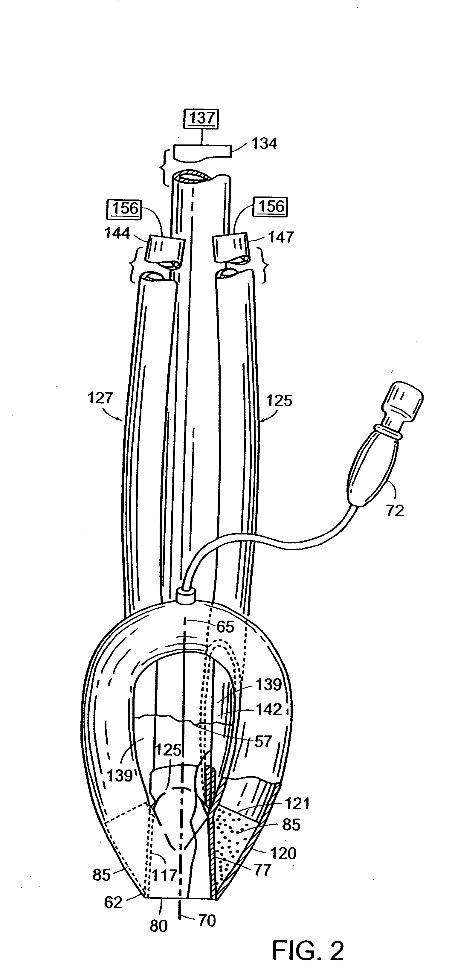 Laryngeal mask with large-bore gastric drainage