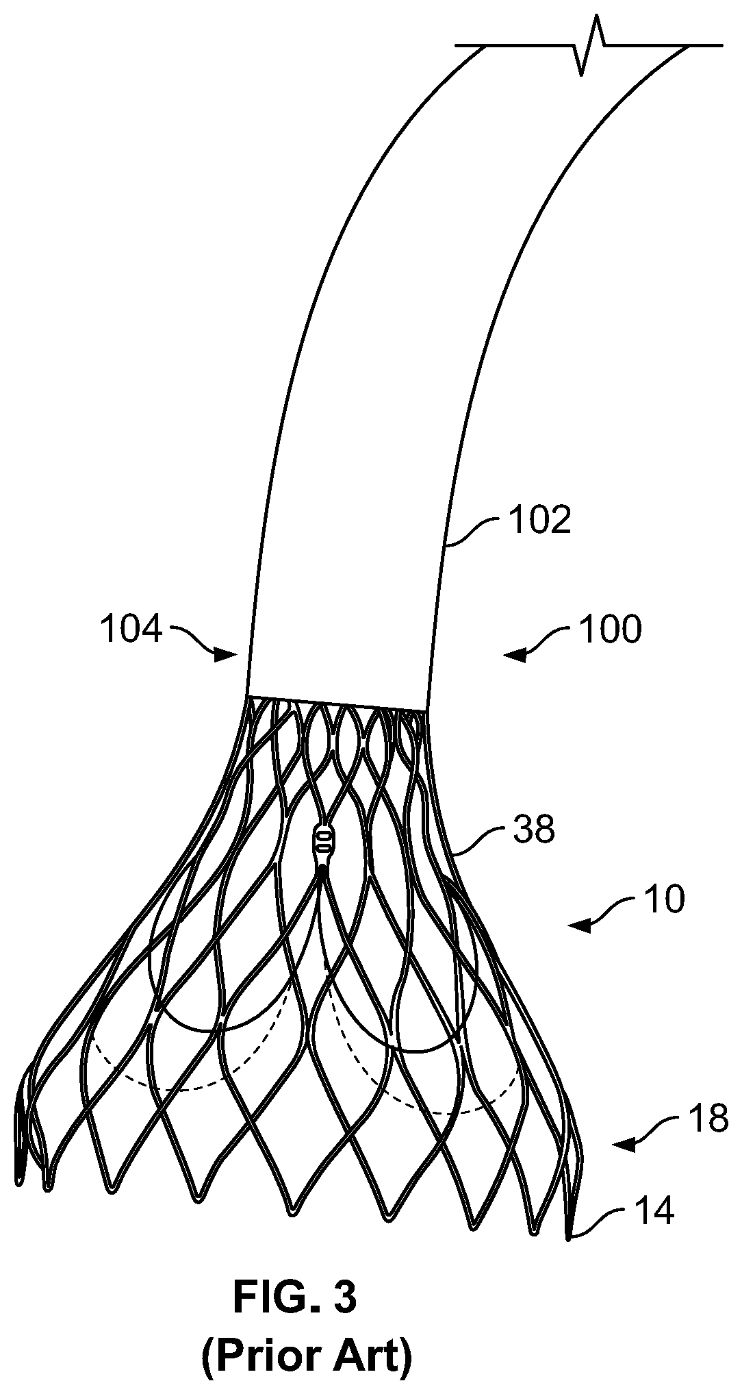 Fully Deployable And Recapturable Prosthetic Heart Valve