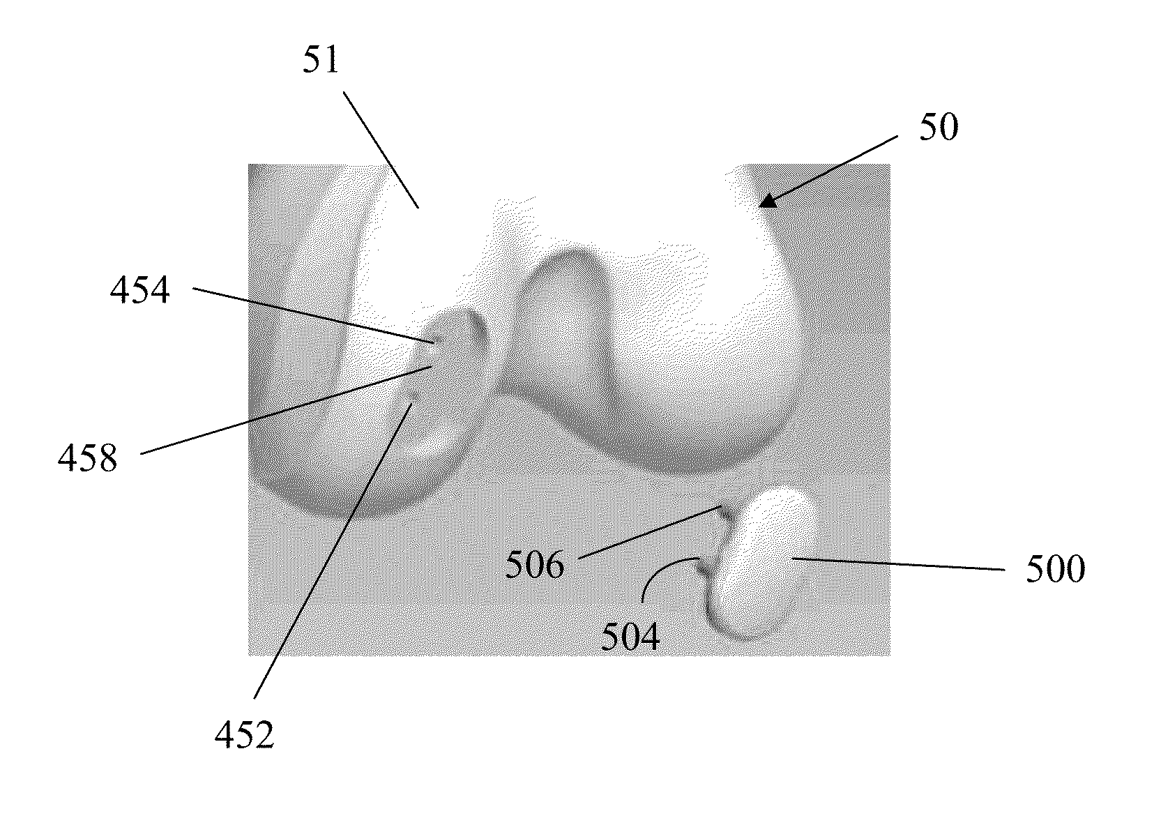 Partial joint resurfacing implant, instrumentation, and method