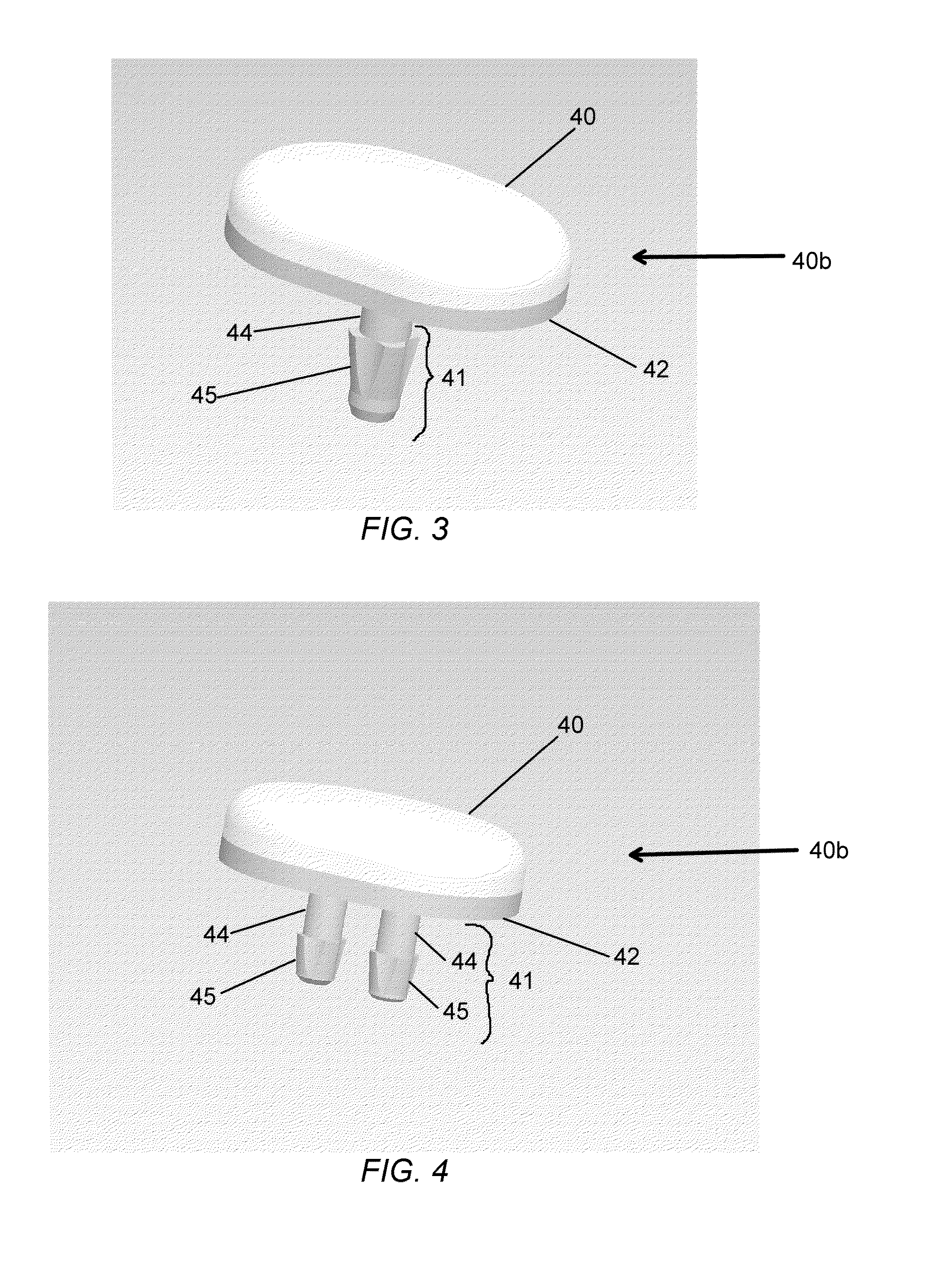 Partial joint resurfacing implant, instrumentation, and method