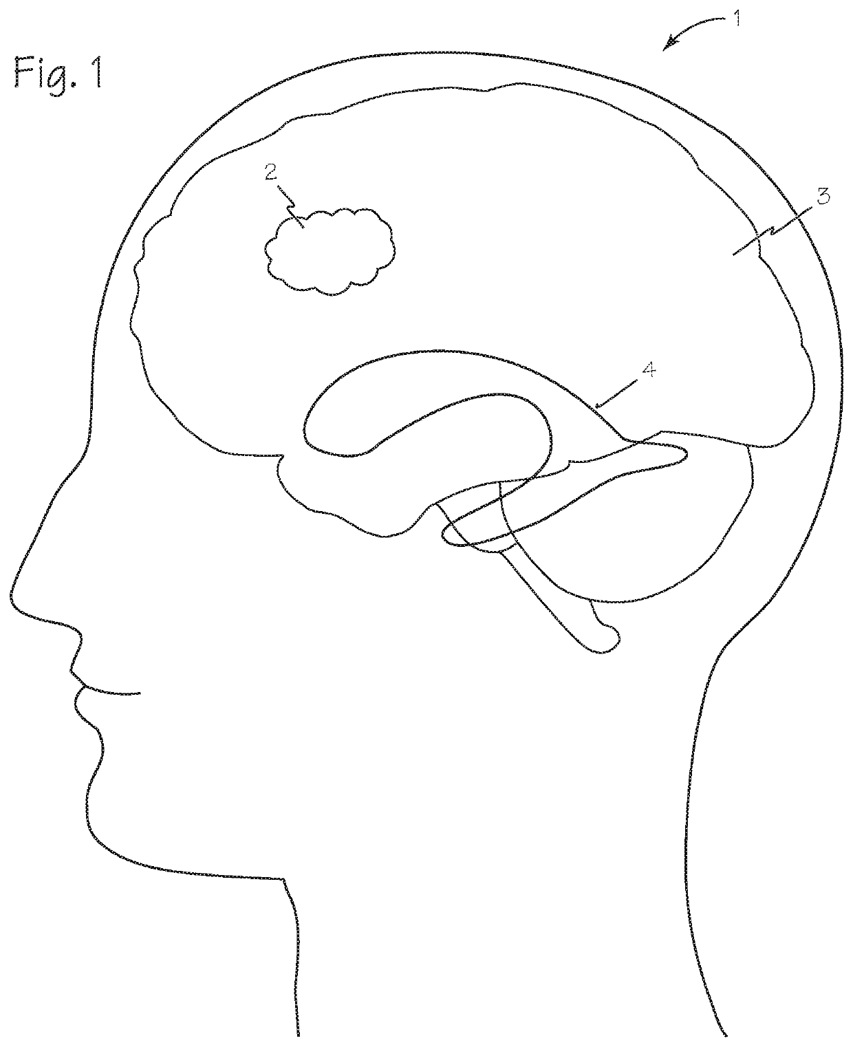 Methods and devices for color detection to localize the blood mass of an intracerebral hematoma