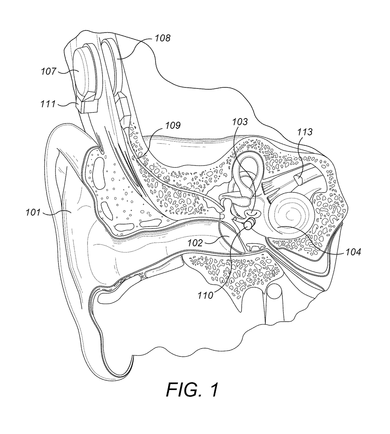 Pre-Load Feedback of a Middle-Ear Coupler