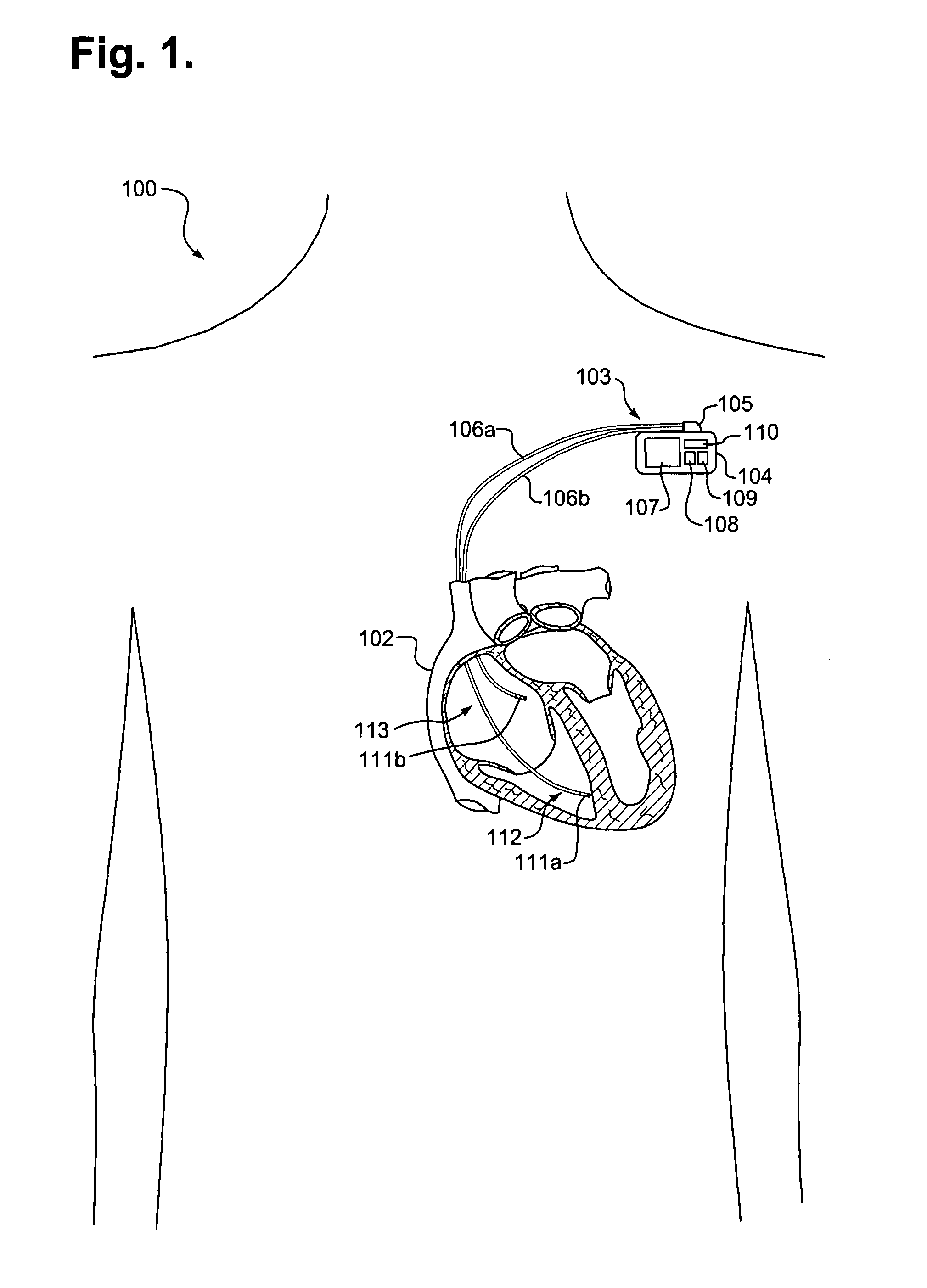 External data processing device to interface with an ambulatory repeater and method thereof