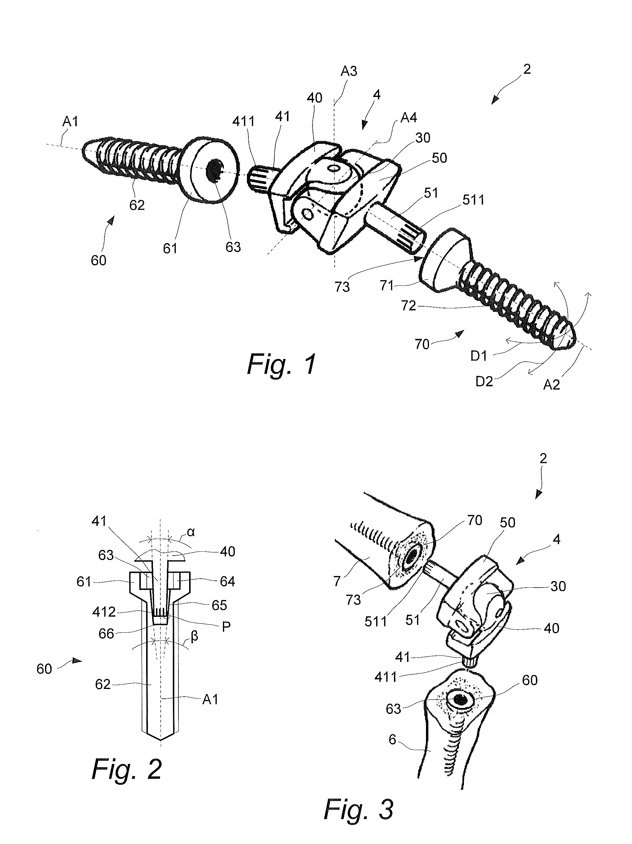 Artificial joint