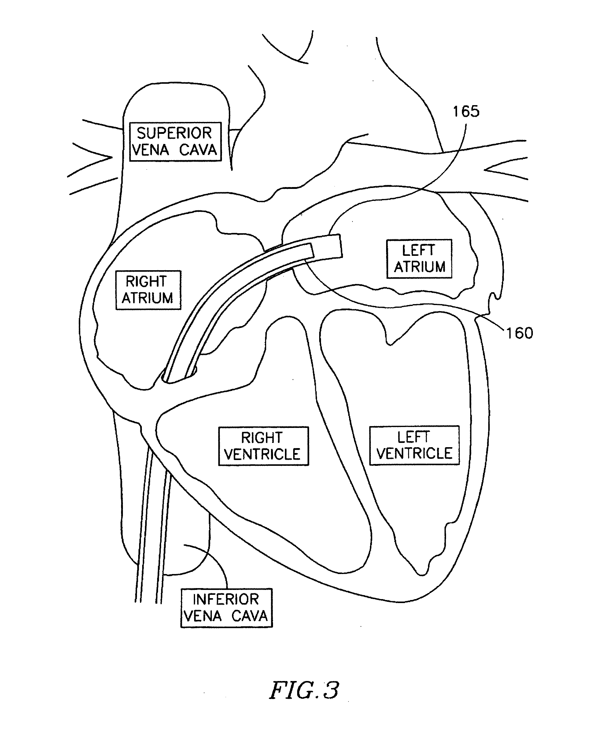 Methods and apparatus for reducing localized circulatory system pressure