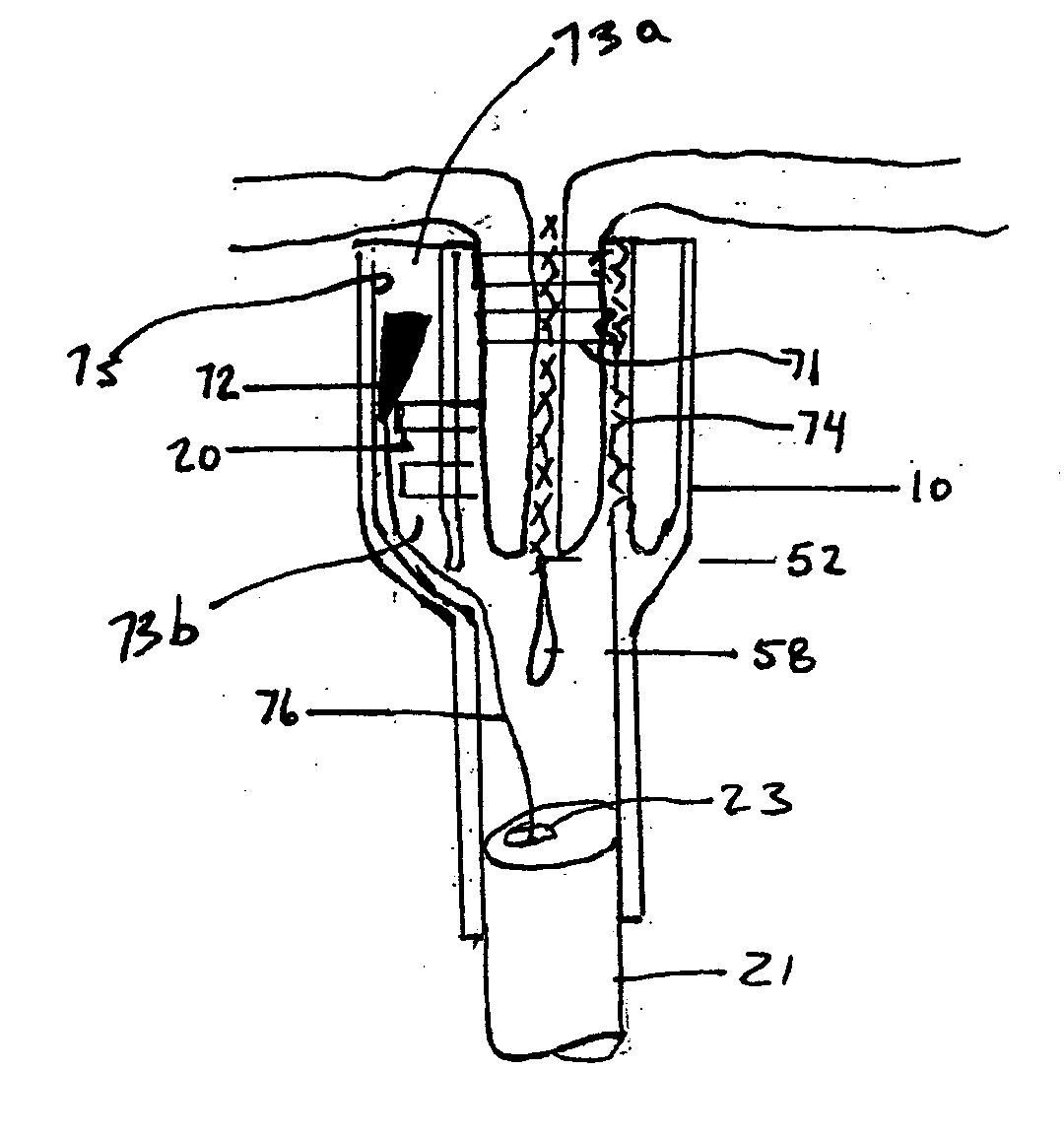 Methods and apparatus for securing an anchor to soft tissue