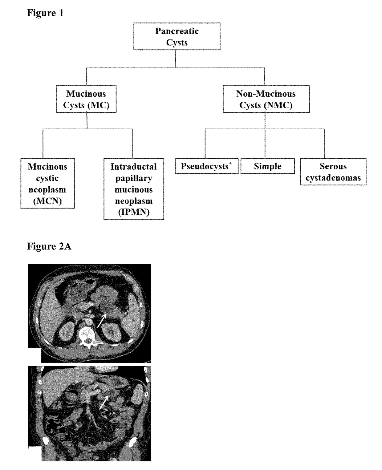 Cyst fluid viscosity as a marker for malignancy