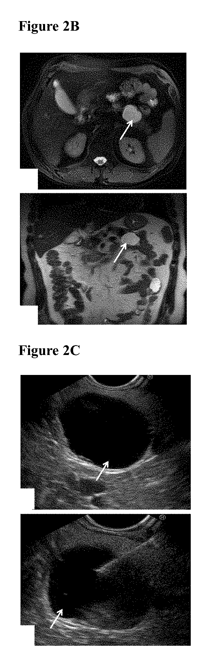 Cyst fluid viscosity as a marker for malignancy