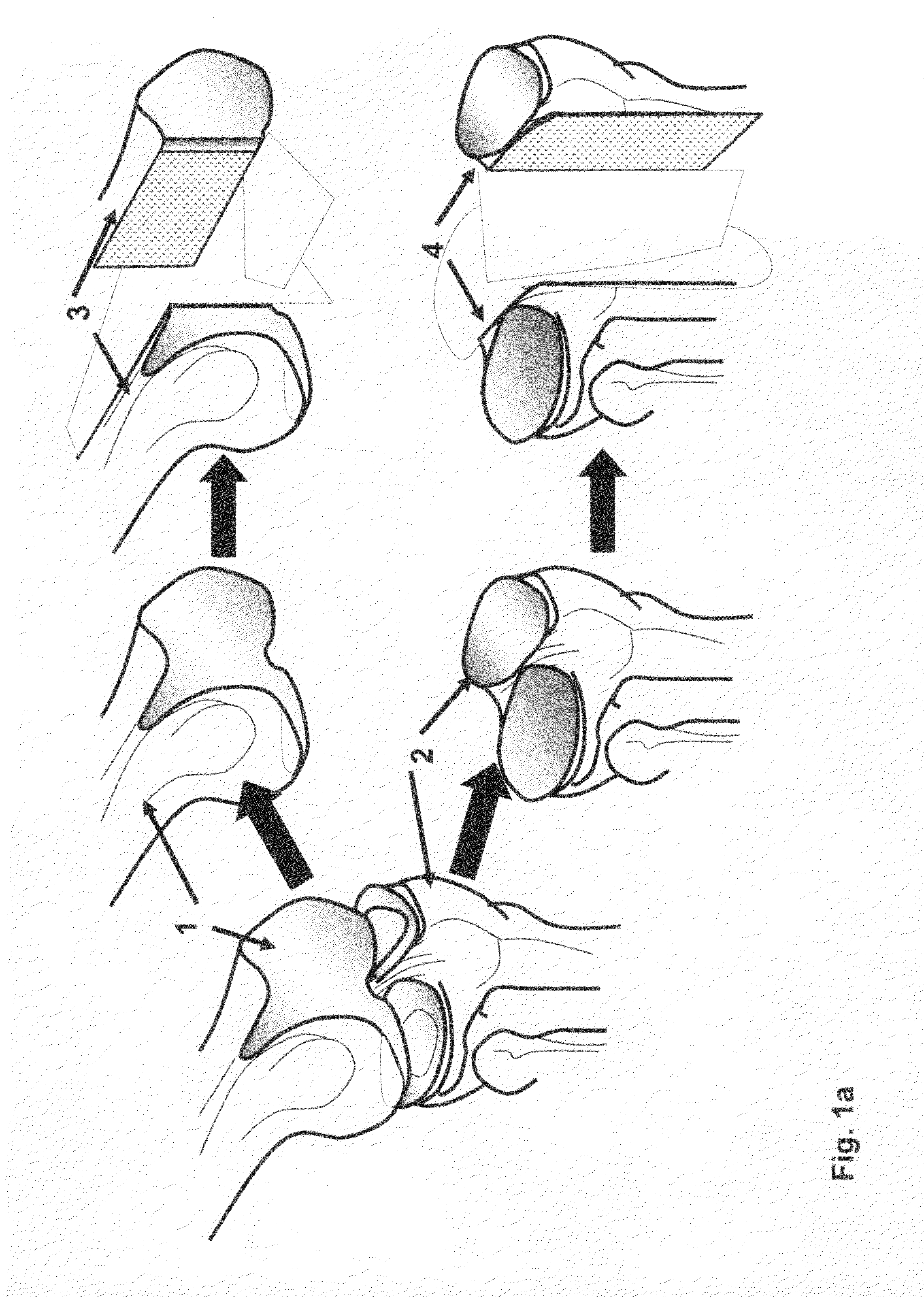 Implantation of cartilage