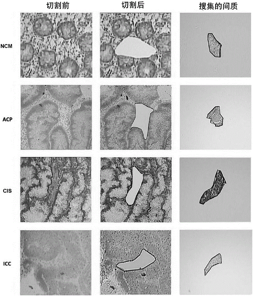 Group of colon cancer metastasis related tumor stroma markers and application