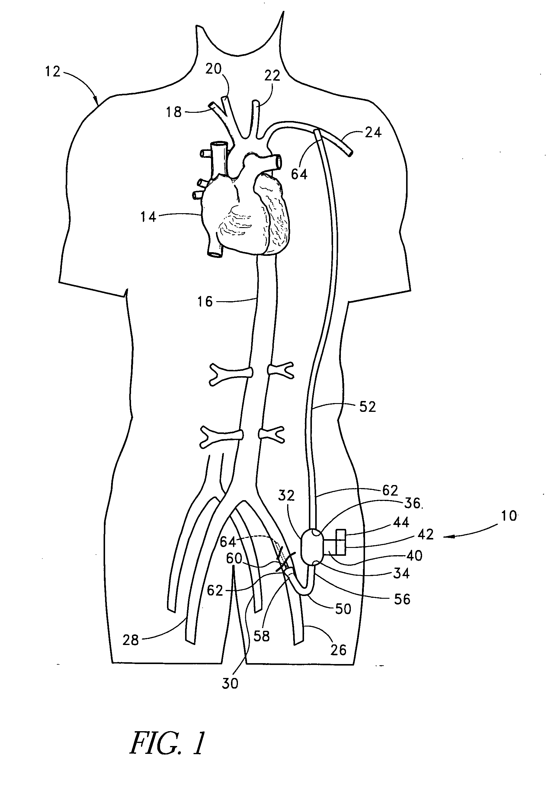 Apparatus and methods for reducing bleeding from a cannulation site