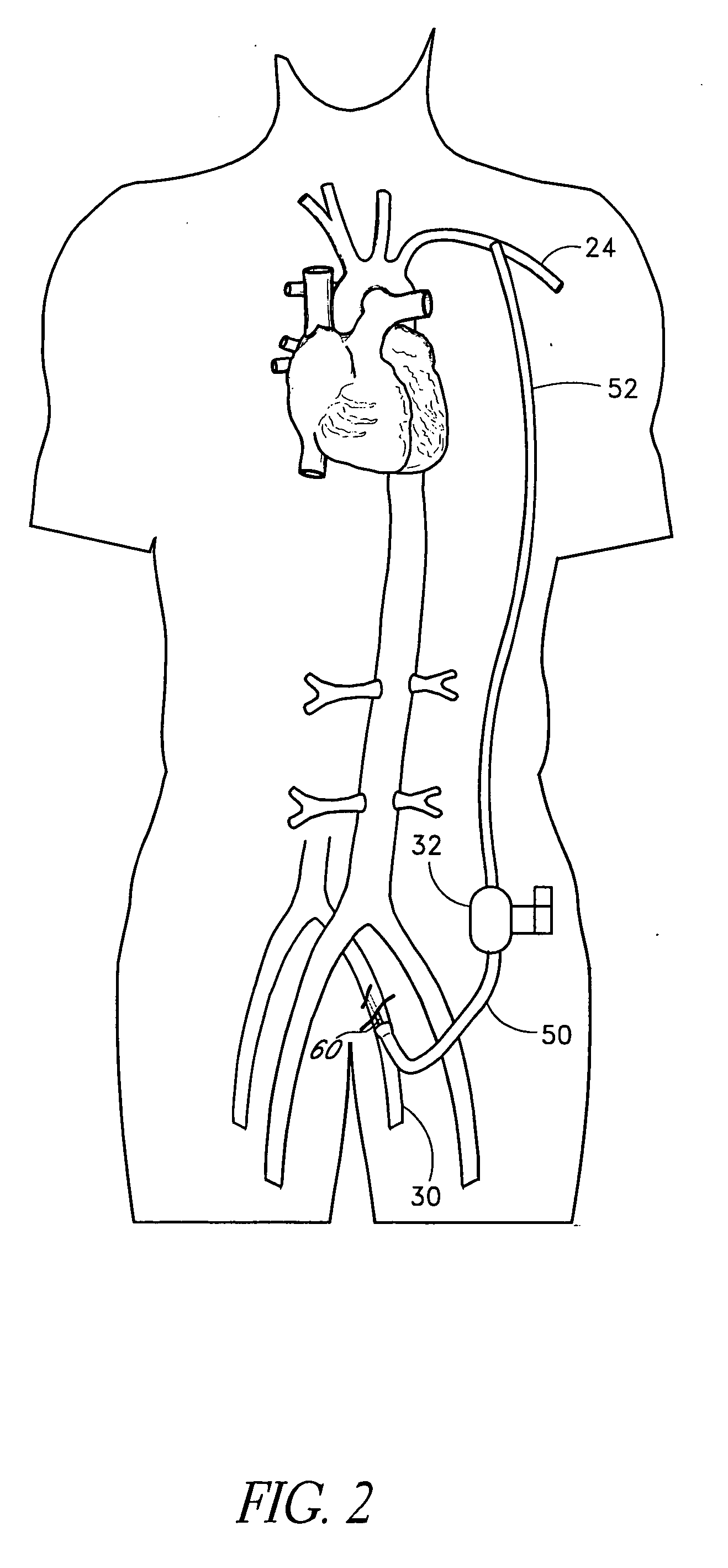 Apparatus and methods for reducing bleeding from a cannulation site