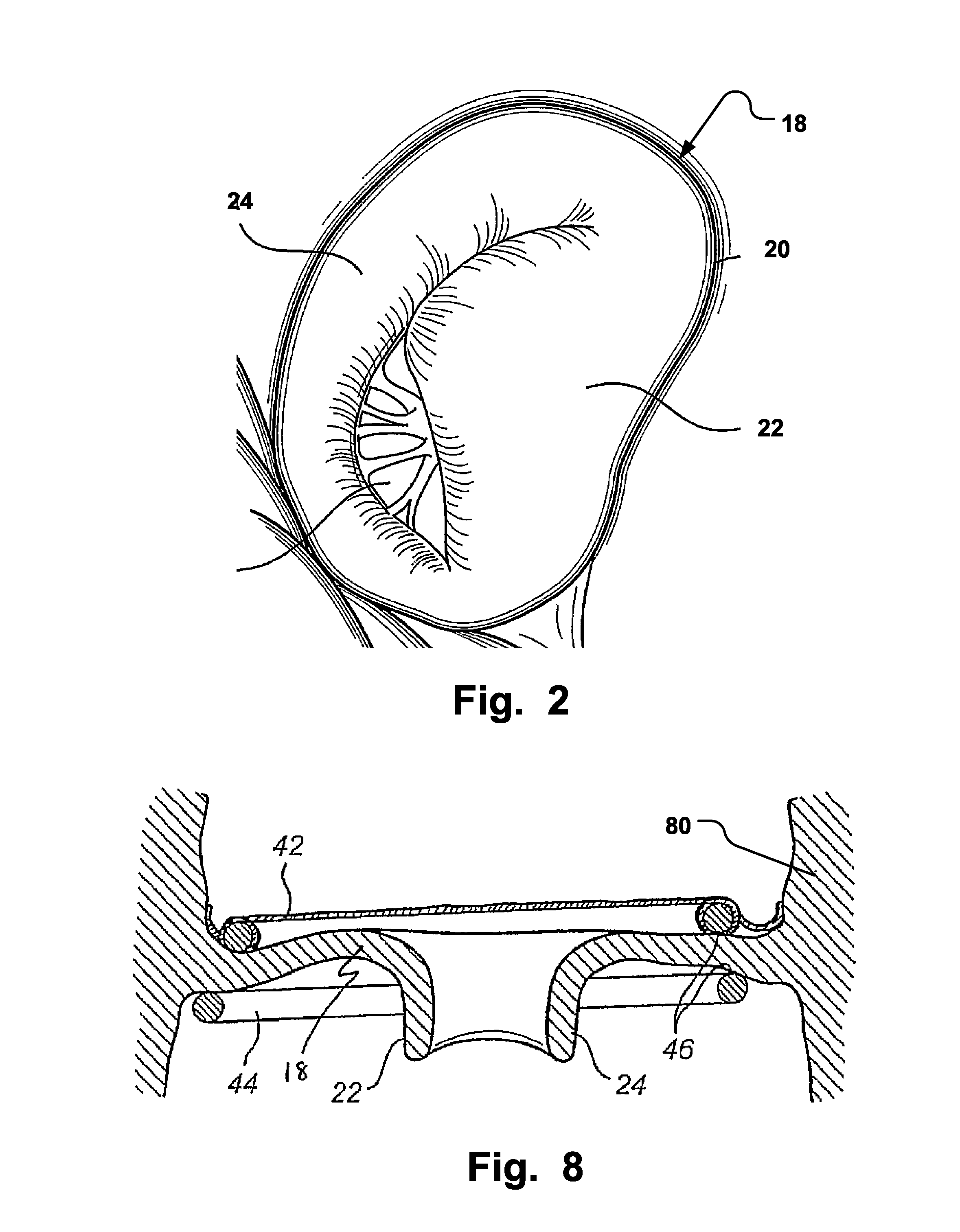 Arrangement, A Loop-Shaped Support, A Prosthetic Heart Valve And A Method Of Repairing Or Replacing A Native Heart Valve