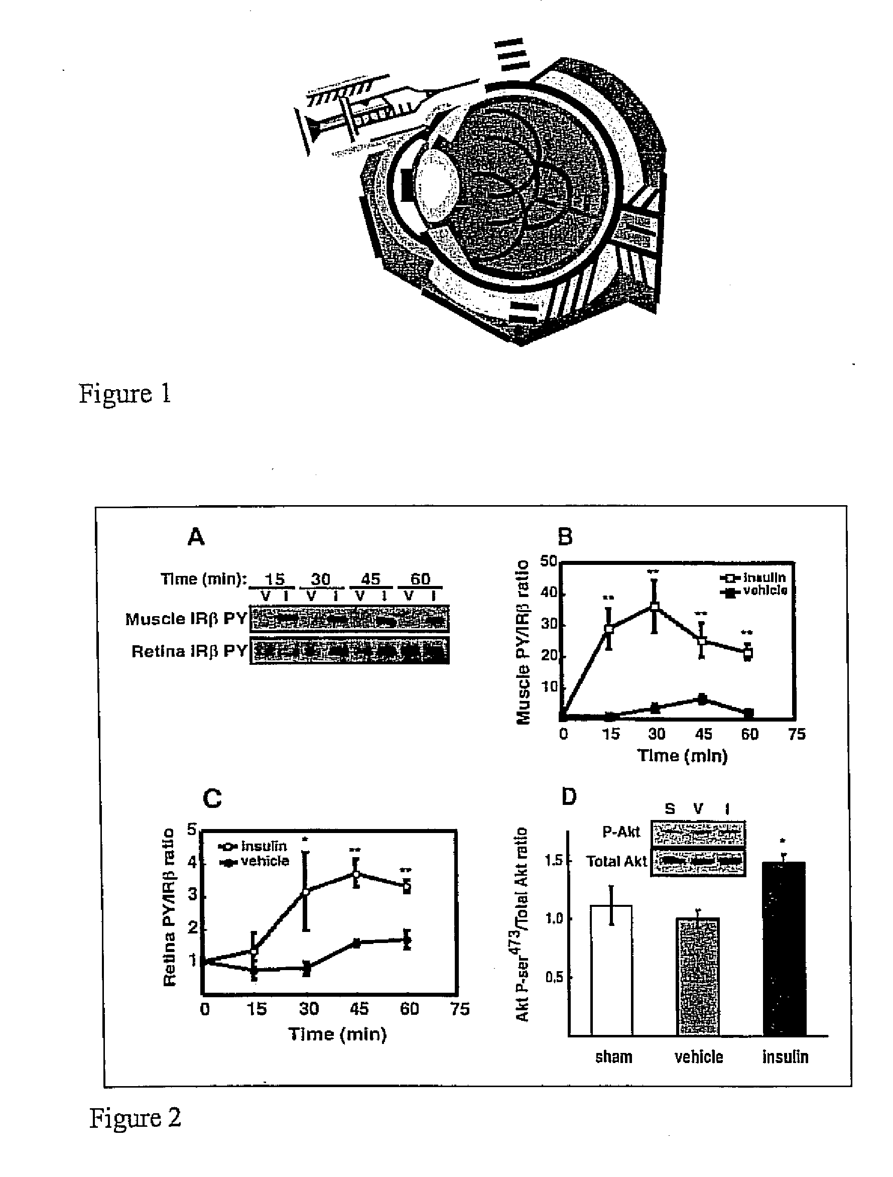 Periocular drug delivery for diabetic retinopathy