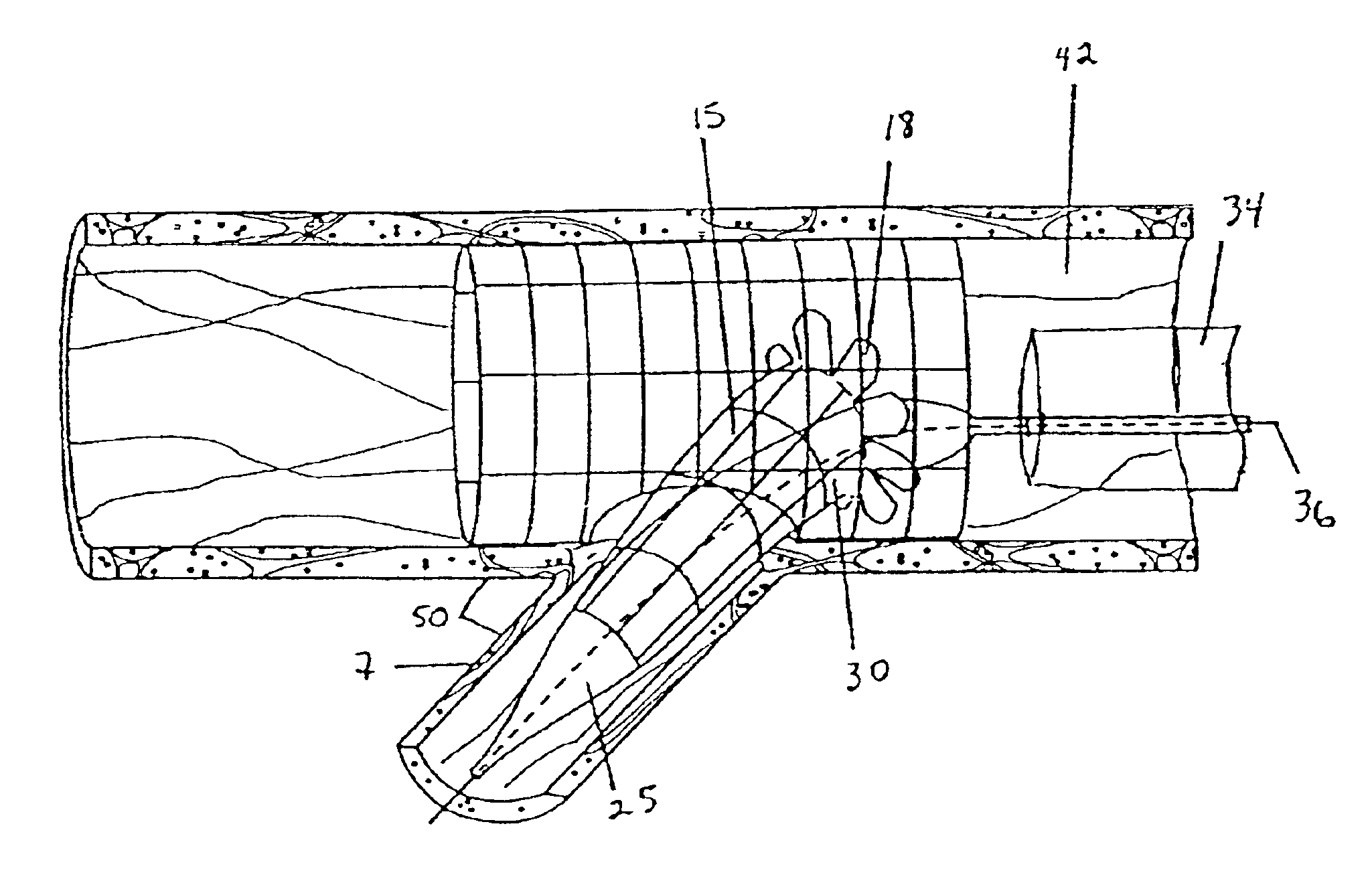 Method for employing an extendible stent apparatus