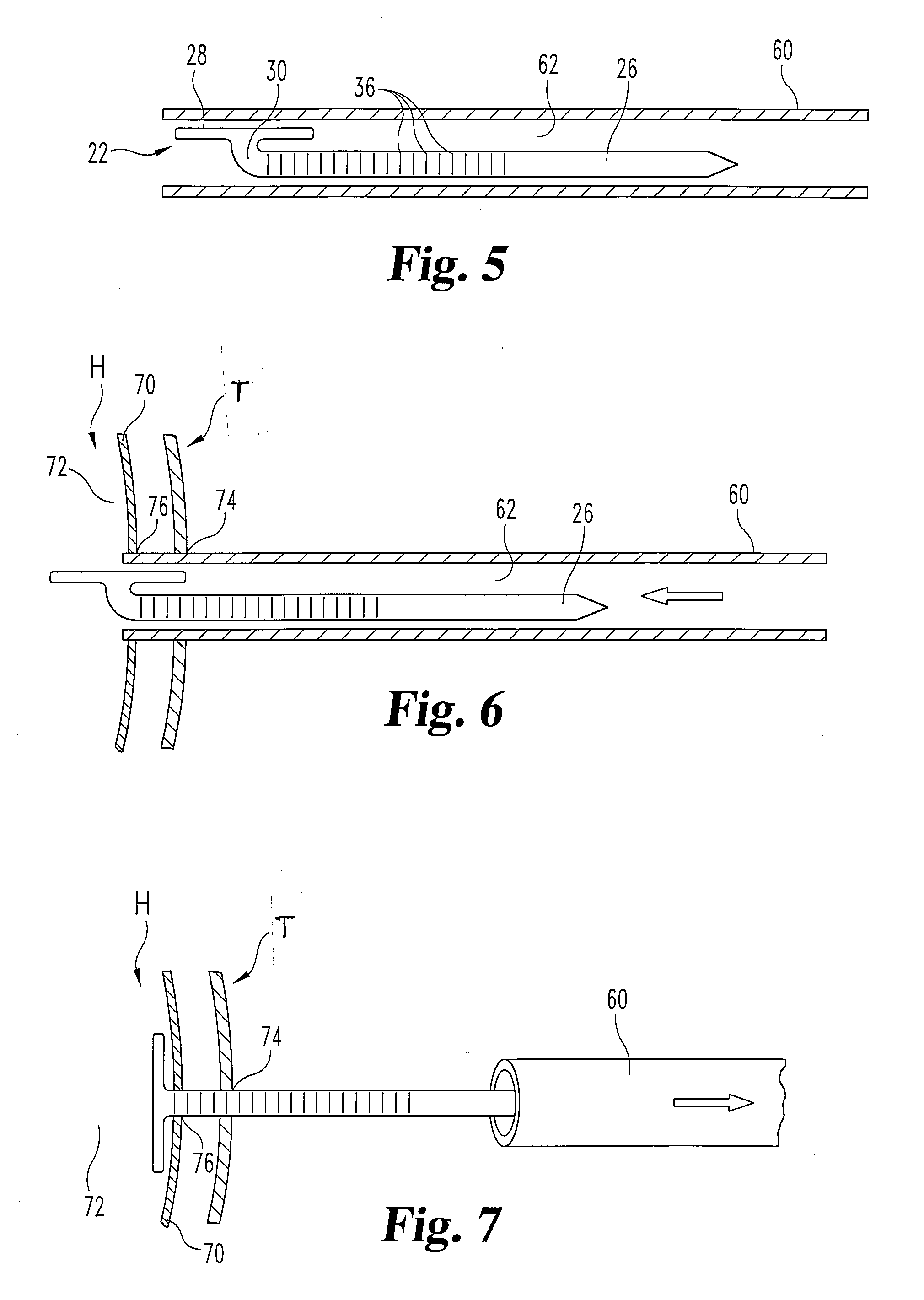 Soft tissue reattachment mechanism