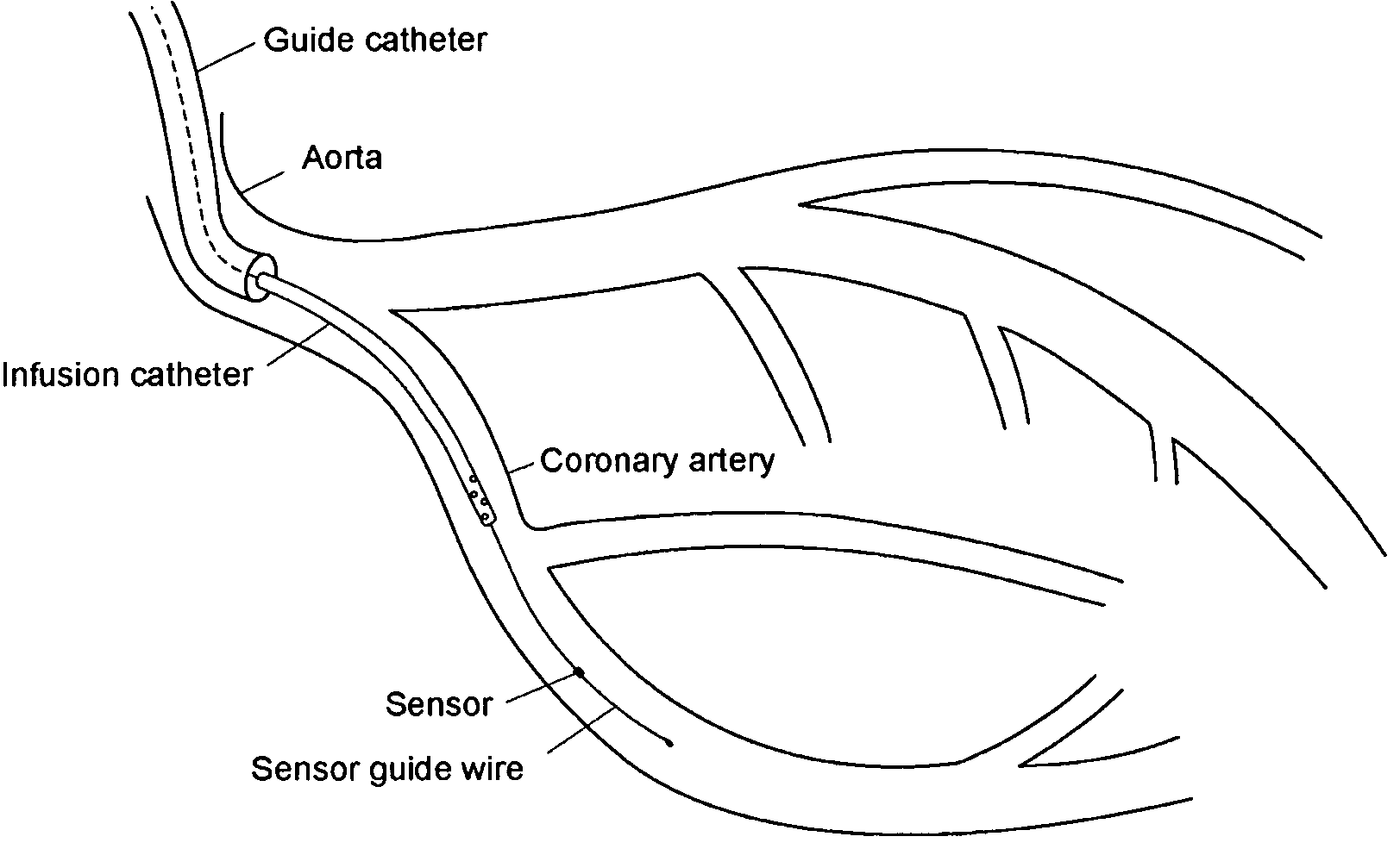 Method for determining the blood flow in a coronary artery