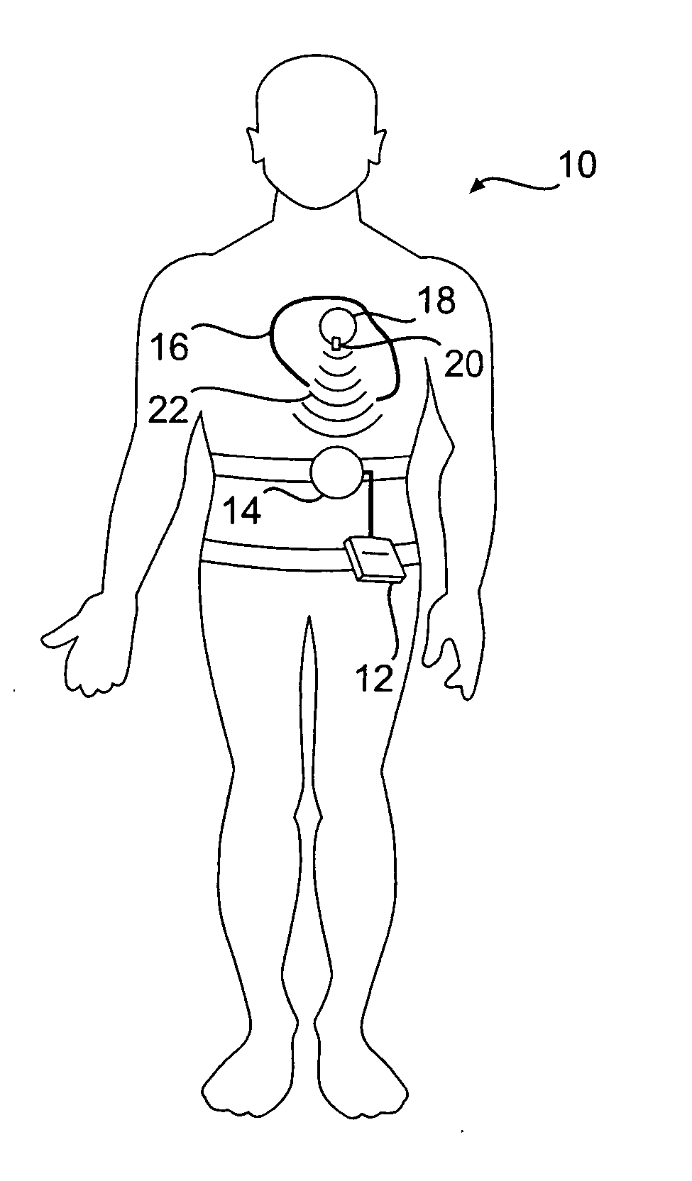 Implantable device for telemetric measurement of blood pressure/temperature within the heart