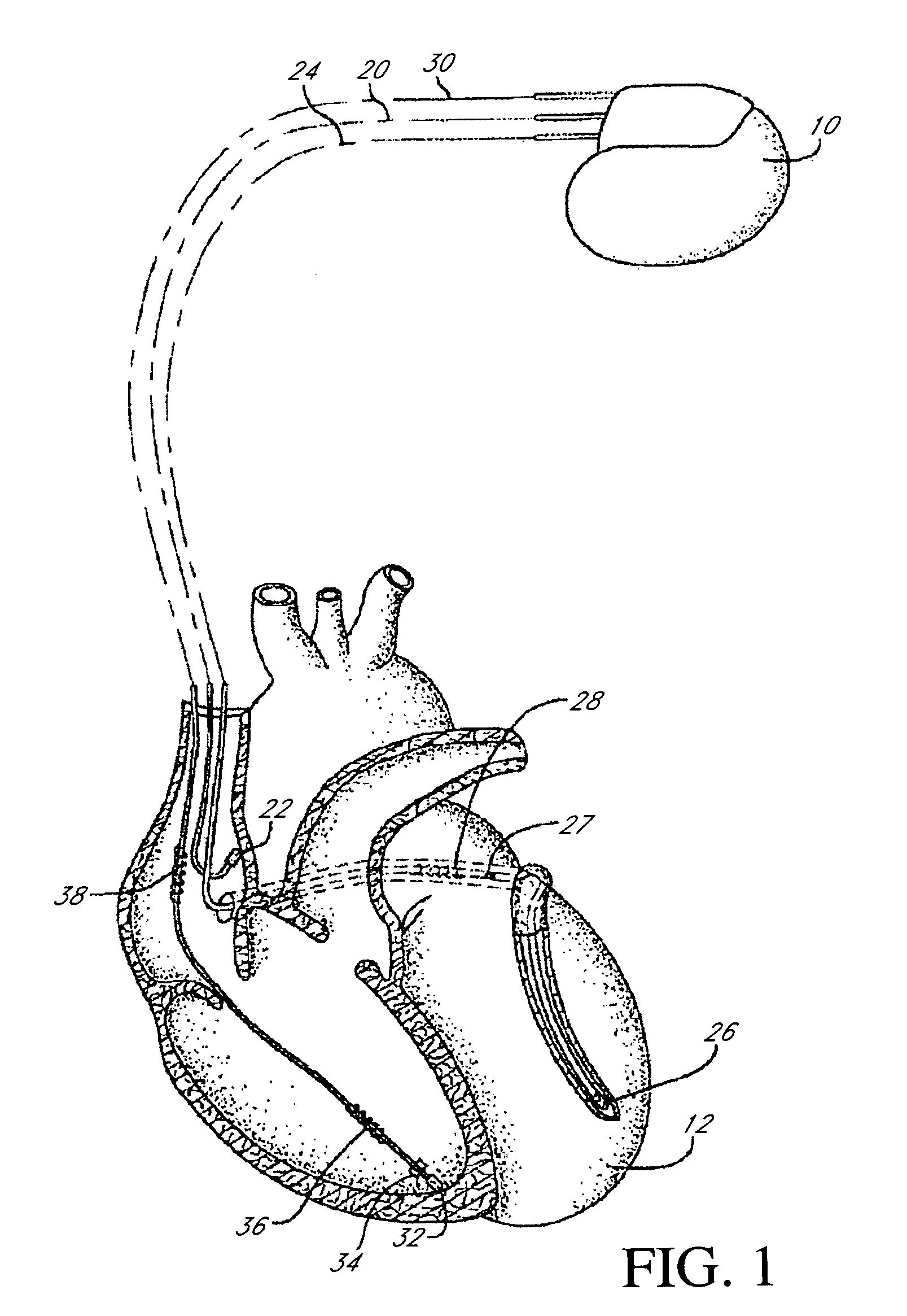 Implantable medical device with automatic sensing adjustment