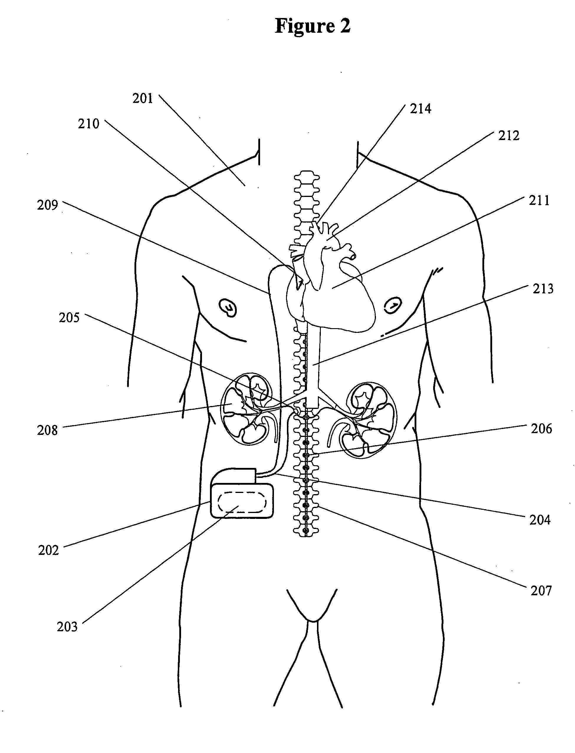 Renal nerve stimulation method and apparatus for treatment of patients