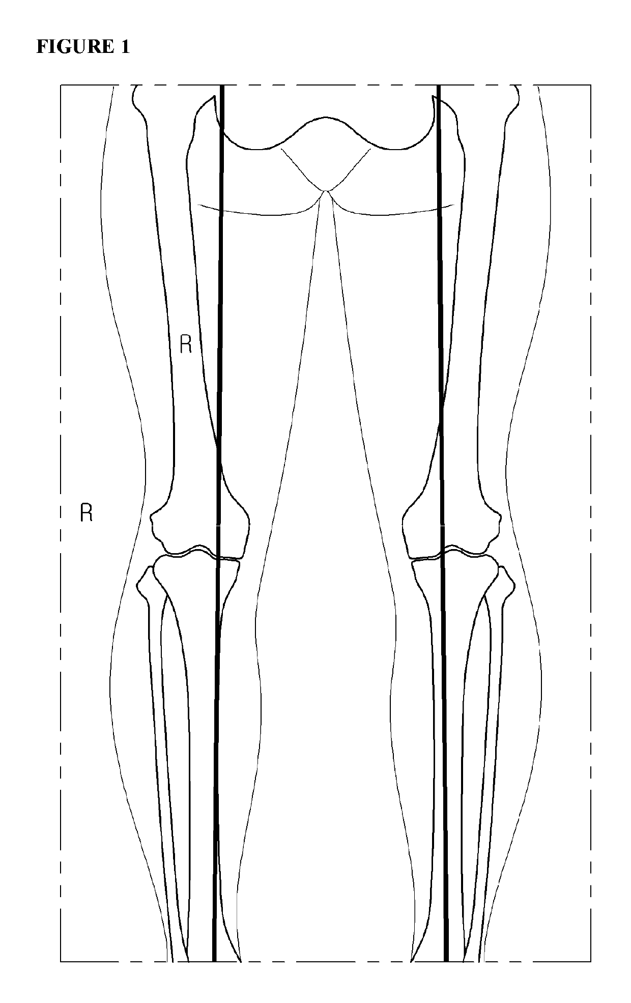 Fixing tool for open-wedge high tibial osteotomy