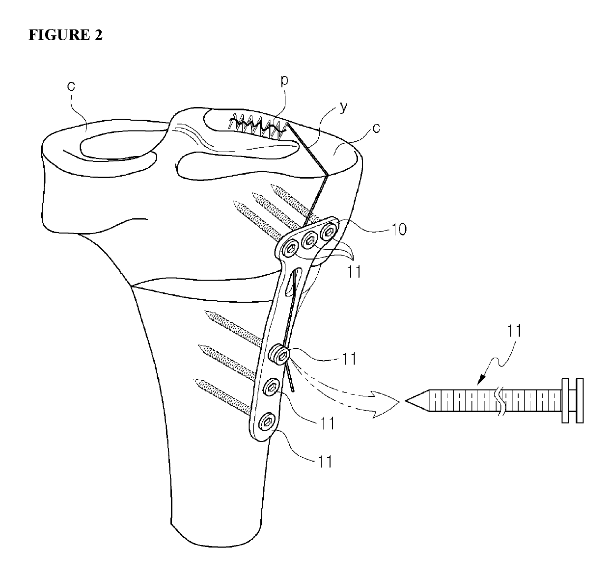 Fixing tool for open-wedge high tibial osteotomy