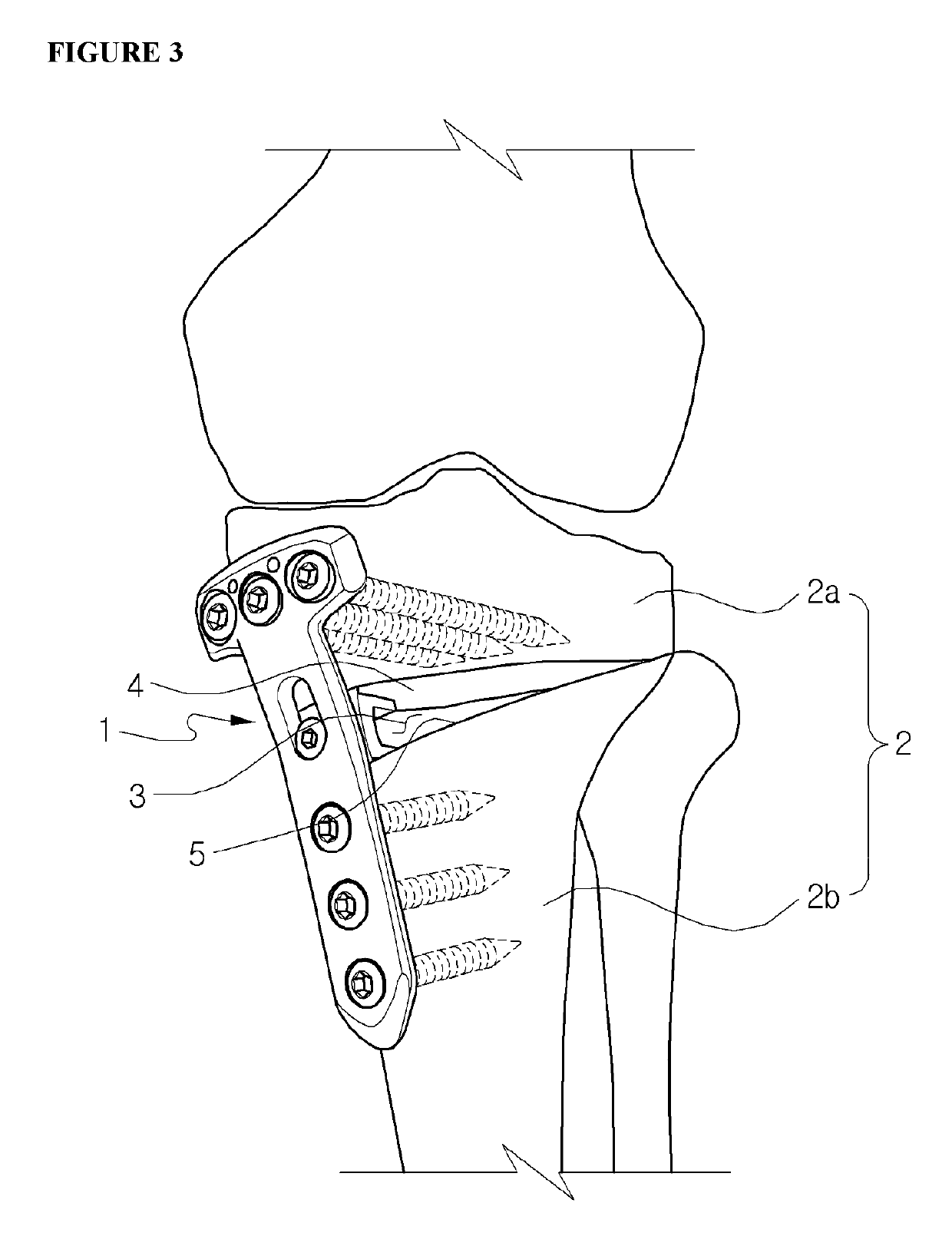 Fixing tool for open-wedge high tibial osteotomy